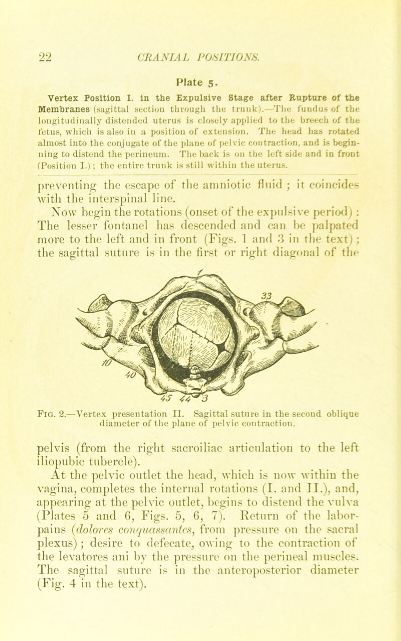 Plate 5. Vertex Position I. ln the Expulsive Stage after Rupture of the Membranes (sagittal section througii the tniiik).—The funduH of the longitudinally distended uterus is closely applied to the hreech of the fetus, wliicli is also in a position of exteiisioii. The head has rotated almost iiito the conjiigatc of the plane of pelvic contraction, and is begin- ning to distend the perineum. The hack is on the left side and in front (Position I.); the entire trunk is still within the uterus. preventing the escape of the aniniotic fluid ; it coincides with the interspinal line. Xow begin the rotations (onset of the expulsive peritxlj : The lesser fontanel has descendod and ean he palpated more to the left and in front (Figs. 1 and 3 in the text); the sagittal sutnre i.s in the first or right diagonal of the Fig. 2.—Vertex presentation II. Sagittal suture in the secoiid oblique diameter of the plane of pelvic contraction. pelvis (from the right sacroiliac articulation to the left iliopubic tnbercle). At the pelvic oiitlet the head, which is now within the Vagina, completes the internal rotations (I. and II.), and, appearing at the pelvic ontlet, hegins to distend the vulva (Plates 5 and 6, Figs. 5, 6, 7\ Return of the labor- jiains (dolores conquassantes, from jiressure on the sacral plexus); desire to defecate, owing to the contraction of the levatores ani hv the pressure 011 the perineal muscles. The sagittal suture is in the antcroposterior diameter (Fig. 4 in the text).