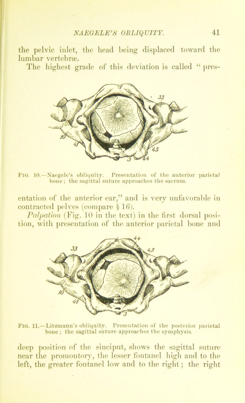 the polvic inlet, tlic head being displaced toward tbe lumbar vertebrfie. Tbe highept grade of tbis deviation is called “ pres- Fig. 10.—Xaegele’s obliqiiity. Preseiitatioii of the anterior parietal bone; the sagittal siiturc ajiproaclies the saeruiu. eiitation of tlie anterior ear/’ and i.s very nnfavorable in contracted pelves (compare § 16). Palpatinv (Fig. 10 in the text) in the fir.st dorsal po.si- tion, with presentation of the anterior parietal bone and Fig. 11.—Litzmann’s obliquity. Presentation of the posterior parietal bone; the sagittal sntnre approaches the syinphysis. deep Position of the sinciput, shows the sagittal sntnre near the proniontorv, tlie le.sser fontanel high and to the left, the greater fontanel low and to the right; the right