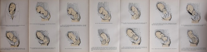 FlO. 9.—Bfow posdoD I. ilirow |>Tesentationl: Encageuient of thc sigit- tal sQtare in tbe tnnsyeree diamctcr. FiG. 30.—As tbc bead descetids it prcs«iiU in tbe left oblique diameUr, brow in front Fio. 31.—The Upper maxilla catrhes on the s^'oipliysis. The riebt frontal cmincncc, Iben the greatcr foutuoci, ond finally tbe occiput ap* pear orer tbo perincum. Pio. 38.—The ebin again a]iproacbcs tbc ehest. Fio. 32.—The occiput cscapcs over tbe perincum. Fio. 39.—After llie hirtli of tbo licad the face turus townrd tlie niutbor'a right thigli, tbo tniiik rotntua abmit its .sngittnl nxis,nud tbc ioft Shoulder iippenis over tlie pcriiieuni. Tliis ia folluwcd tbo birtb of tbc triink nud lower uxtremitics in tbc liiie uf tliu n\is ol ibu pclvic Fig. 33.—Tbc entirc bend is bom, the face and chiii cscaping under tbo sympbysis. Cbanictcristic sbapo of tbe skull in brow posilion.s. FlQ. 40.—Fncc positinn 1., chiii posterior (nnomaly of rotntion), coil- stitutc.s an iinfftvomblc presenlsUion. Tbc verticol linc of tbc face is in tbc first oblique diameter, cliiu tu tbc right and bebiiid. FiQ. 41.—Head rotates iuto the ontcroposterior diameter; ebin posterior. Pio. 42.—Birth of tlic face, cliin posterior. Arm rcflccted Inckwarf cbanictcristic aiinpc of die skull in fiicc pi>siti<iii». Exlroiuc cxtciisiu of die vertebral culuuu. Tbis iiiccbanism is possible oiily in tbe cas of au imtnnturo urgrvatly maccrated fetus.