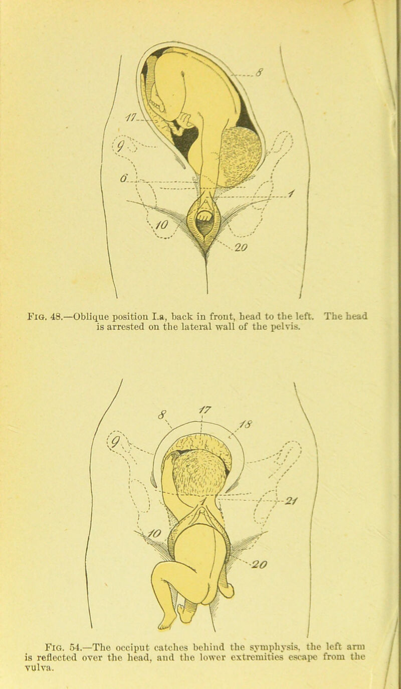 Fiq. 48.—Oblique position I.a, back in front, head to the left. The head is arrested on the lateral wall of the pelvis. Fig. 54.—The occiput catches behiud the syniphysis, the left arm is reflected over the head, and the lower extremities escaiie from the vulva.