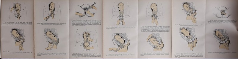 Fig. fl7.—lotrodactioD of the left fmalct blade of thc forci-iB {Kaegele's furceps), held ia the Icft haud and guided by the right, in front of the lefl aicro-iliac artii-ulation, in eraniul podtion L (sagittal SQtut« in the right or Gnt oblique diaineter). Fig. 98.—After the handle has been depressed, the left blade of the for- cep« lies in front of the K-ft sucro-iliac articolation. Fio. 99.—IntruducUon of tho right blade of the foreuiJs, hold in the right band, guidcd by the left, 6rst In front of tbc ri^bt sacro-iliac articulalion and thea by rolotion behind the right iUopectmeal tnbcrcle. Kotation ia cflccted by: (1) DcprcBBing the handle; (2) Botating the blade about ita longitudinal axia; and (3) To tho left (in cranial Position I.). Wbcii tho bcad ü in tho pcivic outict tbo anterior blade of tbe forceps sbould be carried directly forwunl. Big. Ift4.—The aane, seen in aagittal acction: Sagittal sutore in tbc anleroposteriur diametc-r. Fjo. KB.—The bcad begins to appear at the yiiItb and fo bnlee tho penncuui forward. By ulcvuting the haiidlcs the forceps is now gradu- ally changed from Position II. into podtion III. Latcnl iuclsiona if neccasary. FlO. 106.—Tmction, or rather lovering, in Position III. Tho bandtes nre enrned obhquely upwurd Umard the abdomen; the fiicc is broiigbt out overthe pcrincnin, wliich mugtbccarcfblly protcctcd. In priinipann it IS better to rcrooTO the forceps and deliver tho face by SineHie-Kitgen’s method (Fig. 11).  Fig. 100.—Locking of tbe forceps in podtion 1.; tbc left blude lies iu front of the Icft sncrodliac articiilutiou ; the elbovv is (hcroforo in the left oblique diameter. Fiu. 107.—Tbc same, scen in sngiltal acction. Tbc sboulders are then doliTcrcd by alteriialely eloviiting niid dopressing tbc bcad, or iifter the inaiiDcr showu in Fig. tOS. Fio. 101.—Trial tmction in position I., ohliqucly dowiiward wheu tbe bcad ü high (at tbc lovcl of tbc iiilct). If tbc bcad is low, tho forceps is imiDcdiately broiight into tbc second Position—horisontal. Oue dngcr is placcd on the advancing head (scen io frontal section) to toake BUro tbat uonc of tho soft muteriinl pnrts or a prolupsed uuibilical cord bas been inclodcd iu tho grasp of tbe forceps and to determine tvlicthcrtbo bcad follows tlie pull of tbc instrumentaud rotutes propcrly. Fig. 192.—Trial tmction in Position I. (scen in sagittal section). Tbo sagittal sutuio is rotated into tbo coidugato. Pio. 103.—Tmction iu position II. afler tbo head lias di’^ccnded. A» soon 08 tbo head lios enlcred tbc plane of pulvic coiitraction tbe hundloa are rulscd to tbo liorisoiital pusicion. (Tfaoy sbould bc dnC loeseocd and ivupplied to tbo sides uf tbo bcad.) FbG. 108.—Extraction by bookiiig tho right iiidcx finger into tbo posterior Icft nsilla, ciimbined willi expression by pressure on tlie brecch, The tniiik is pusbed dowuwnrd and agaiust the porincum (Krislcller's uietbod). Fic. 109.—Sagittal viow of tho forceps in position In tho Icft (II.) obliquo diainctor, wliou tho hc-ad is high and in tlie ]iroper positiuu for tbe applicution of tbe forceps (gruat^t peripbery nt tbc pelvic inlet,os fully dilatcd). Cranial position I., sagittal suturo in tbo transvene diatucUir. Frontal cmlucuccs at tbo levcl of tbo iUopcctiucal Uno or a littlo lower. Fio. IIU.—Tmction liriit in pnsitiim I., in prcsculatiou of the oatcrinr fouQlDC), thou—
