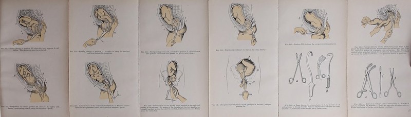 l'Ki. 111.—Dirwl chJiiBv Io i«wtinii 111. wbtn ihc liiiul a|ilH-urs ilt llie Tulvs. Thi-jiriucum mu»t be jimU-cI«!. Fi*.. IIT.—l’crfontimi in crniibil {■»iüi>u 11. (WU (■> ilic rixlil) wiili Lcvret'» pcrf<initi:iB wi-Min. using tbu Öuger lu tt guidt.-. 1 Flti. 112.—Fliially, chaiigu lu i>u$iiiuu 11., iu üidur to briug tbc siüciput out fruin undiT ttio symphysis. Fiü. Ul.—Tnictiou in iiusitioii I. tu dtpri-ss tbu cliiu, liunlly— !':u. 130.—Uetai<itu(iou wilb llruuii’s buuk {prülupä« uf iiii arui); obli.iuu Position I.a. b Fio. 121.—ti, Hoiio foroops (in traniiHilnsis); 6, sliiirp I,ovrct’8 buuk (esfractionl; c, foruops für tbo rcmovol of pliicenlul reiuaiu» and aftur iibortiim rf. Scbiiltze's sirklc-sbaped kiiifc (embryutmnyi. Fto. llü.—Forccjis dolivory uf tlic artorconiiiig buud ivlu-ii it boa passcd tbc pclvio iiilet auil tbu uioulli raiiiiut lie rcuvbwl (seu Figs. 70 t« Ti) cniployi'd inslcad of expns'iou ntiil oxtnictioii, Tbu furcep* la iiiipliud bflovv. or nitiiui' iM-biiid. (bo fotiil tniiik, tbo luttur buiiiK ciirriLHl I up towiinl tbc iiiütbur’sabdmuuii. Tbu |iuriiiuuin aliciiilil Itu imJtui luil. Fi(i 122Eximctiou fimup*! iiiflur cniiiindiwLa, l„ Wiiickul’a pultcrii iitiprovcd by Mosimnl); /. ciirut für uw uftcr obnrticm; iiiid, g. düublu luiinculum Io llx tbo uorvis duriiig curutbigu.