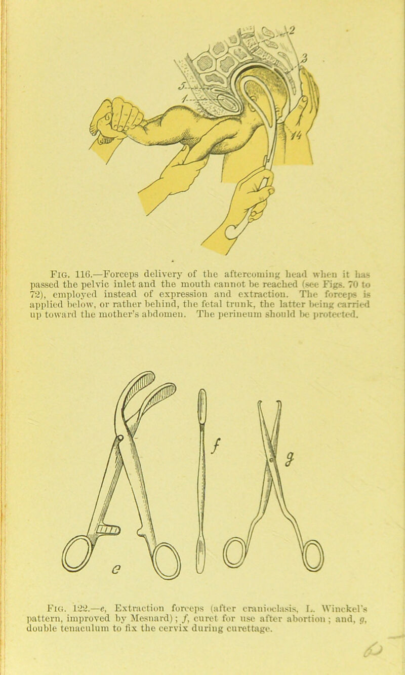 1 Fig. 116.—Forceps delivery of tbe aftercomiiig bead wlieii it bas passed tbe pelvic inlet and tbe moutb cannot be reached (see Figs. 70 to 72), employed instead of expression and extractiou. Tbe forceps is ay)plied below, or ratber bebind, tbe fetal trnnk, tbe latter being cam'ed up toward tbe motber’s abdomeii. Tbe periuenm sboiild lie protected. Fig. 122.—e, Extraction forceps (after cniniocia.sis, L. Winckel's ])attei-n, iinproved by Mesnard); /, curet for use after abortion; and, g, double tenaciiliim to fix tbe cervix during curettage.