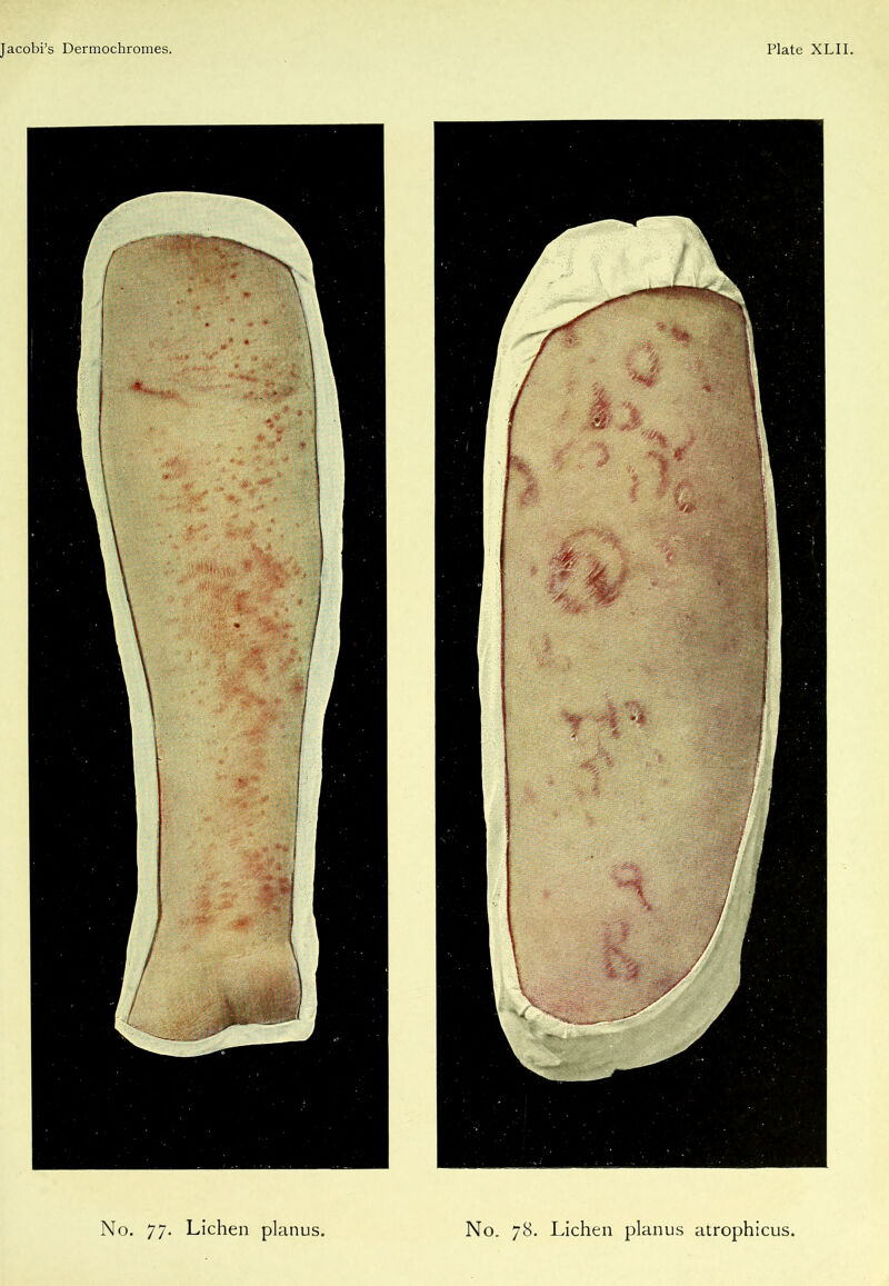 No. 77. Lichen planus, No. 78. Lichen planus atrophicus,