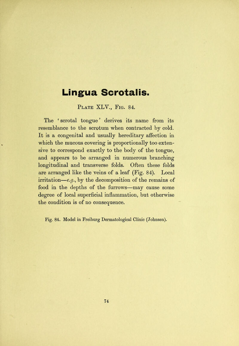 Lingua Scrotalis. Plate XLV., Fig. 84. The ‘ scrotal tongue ’ derives its name from its resemblance to the scrotum when contracted by cold. It is a congenital and usually hereditary affection in which the mucous covering is proportionally too exten- sive to correspond exactly to the body of the tongue, and appears to be arranged in numerous branching longitudinal and transverse folds. Often these folds are arranged like the veins of a leaf (Fig. 84). Local irritation—e.g., by the decomposition of the remains of food in the depths of the furrows—may cause some degree of local superficial inflammation, but otherwise the condition is of no consequence. Fig. 84. Model in Freiburg Dermatological Clinic (Johnsen).