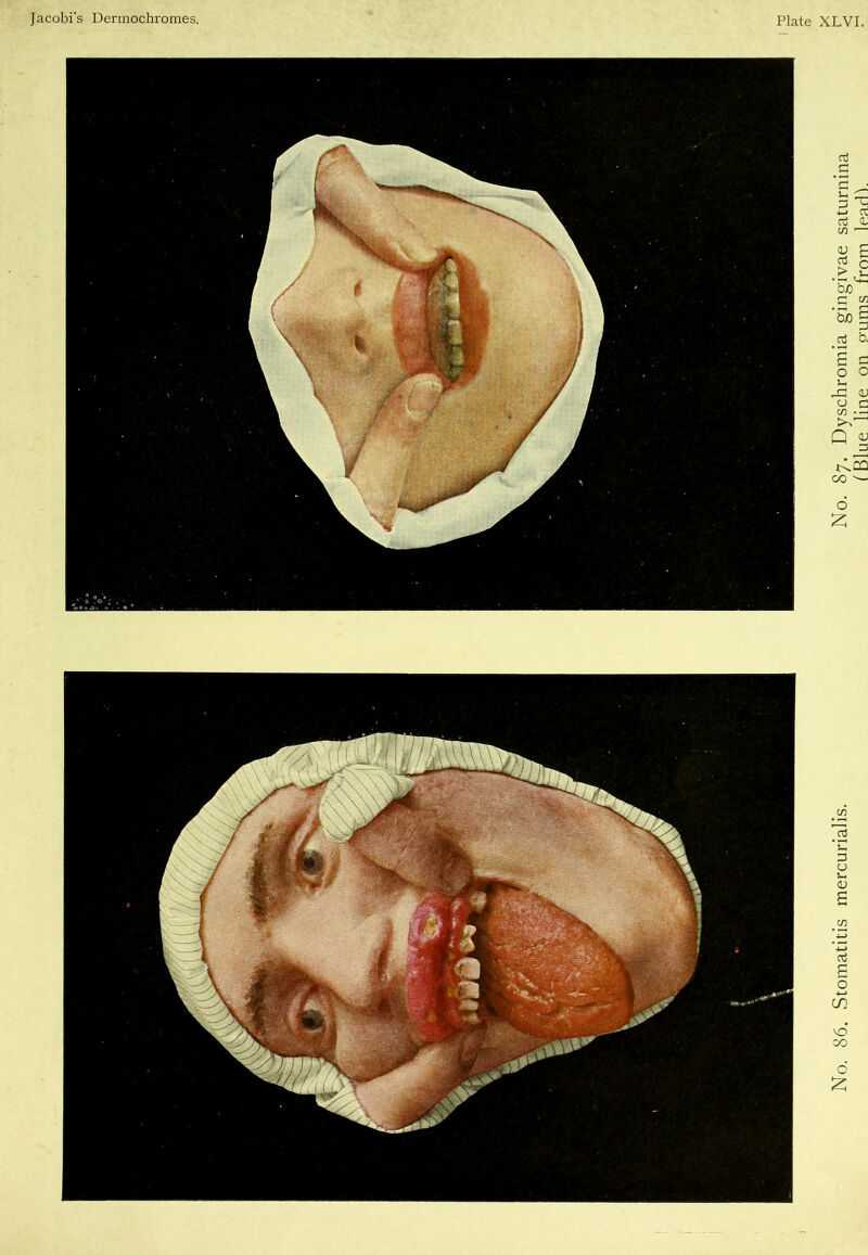 Jacobi's Dermochromes. Plate XLVI. No. 86. Stomatitis mercurialis. No. 87. Dyschromia gingivae saturnina (Blue line on ?ums from leadh