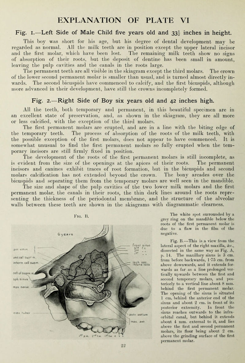 Fig. i.—Left Side of Male Child five years old and 33^ inches in height. This boy was short for his age, but his degree of dental development may be regarded as normal. All the milk teeth are in position except the upper lateral incisor and the first molar, which have been lost. The remaining milk teeth show no signs of absorption of their roots, but the deposit of dentine has been small in amount, leaving the pulp cavities and the canals in the roots large. The permanent teeth are all visible in the skiagram except the third molars. The crown of the lower second permanent molar is smaller than usual, and is turned almost directly in- wards. The second bicuspids have commenced to calcify, and the first bicuspids, although more advanced in their development, have still the crowns incompletely formed. Fig. 2.—Right Side of Boy six years old and 42 inches high. All the teeth, both temporary and permanent, in this beautiful specimen are in an excellent state of preservation, and, as shown in the skiagram, they are all more or less calcified, with the exception of the third molars. The first permanent molars are erupted, and are in a line with the biting edge of the temporary teeth. The process of absorption of the roots of the milk teeth, with the possible exception of the first molars, does not appear to have commenced. It is somewhat unusual to find the first permanent molars so fully erupted when the tem- porary incisors are still firmly fixed in position. The development of the roots of the first permanent molars is still incomplete, as is evident from the size of the openings at the apices of their roots. The permanent incisors and canines exhibit traces of root formation, but in the bicuspids and second molars calcification has not extended beyond the crown. The bony arcades over the bicuspids and separating them from the temporary molars are well seen in the mandible. The size and shape of the pulp cavities of the two lower milk molars and the first permanent molar, the canals in their roots, the thin dark lines around the roots repre- senting the thickness of the periodontal membrane, and the structure of the alveolar walls between these teeth are shown in the skiagrams with diagrammatic clearness. Fig. B. The white spot surrounded by a grey ring on the mandible below the roots of the first permanent molar is due to a flaw in the film of the negative. Fig. B.—This is a view from the lateral aspect of the right maxilla, tfcc., dissected in the same way as Fig. A, p. 14. The maxillary sinus is 3 cm. from before backwards, l-75 cm. from above downwards, and it extends for- wards as far as a line prolonged ver- tically upwards between the first and second temporary molars, and pos- teriorly to a vertical line about 8 mm. behind the first permanent molar. The opening of the sinus is situated 1 cm. behind the anterior end of the sinus and about 2 cm. in front of its posterior extremity. In front the sinus reaches outwards to the infra- orbital canal, but behind it extends about 4 mm. external to it, and lies above the first and second permanent molars, its floor being about 2 cm. above the grinding surface of the first permanent molar.