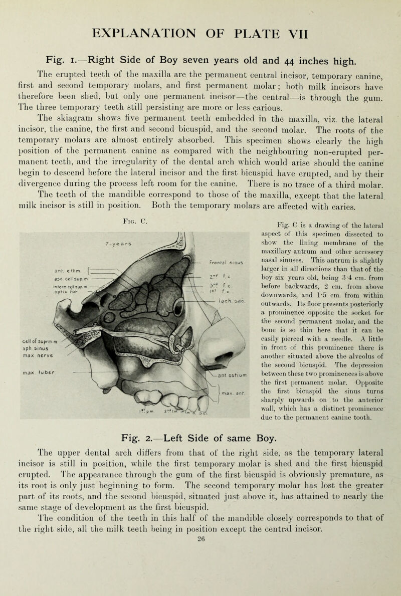 Fig. i.—Right Side of Boy seven years old and 44 inches high. The erupted teeth of the maxilla are the permanent central incisor, temporary canine, first and second temporary molars, and first permanent molar; both milk incisors have therefore been shed, but only one permanent incisor—the central—is through the gum. T he three temporary teeth still persisting are more or less carious. The skiagram shows five permanent teeth embedded in the maxilla, viz. the lateral incisor, the canine, the first and second bicuspid, and the second molar. The roots of the temporary molars are almost entirely absorbed. This specimen shows clearly the high position of the permanent canine as compared with the neighbouring non-erupted per- manent teeth, and the irregularity of the dental arch which would arise should the canine begin to descend before the lateral incisor and the first bicuspid have erupted, and by their divergence during the process left room for the canine. There is no trace of a third molar. The teeth of the mandible correspond to those of the maxilla, except that the lateral milk incisor is still in position. Both the temporary molars are affected with caries. Fig. C. Fig. C is a drawing of the lateral aspect of this specimen dissected to show the lining membrane of the maxillary antrum and other accessory nasal sinuses. This antrum is slightly larger in all directions than that of the boy six years old, being 3'4 cm. from before backwards, 2 cm. from above downwards, and l-5 cm. from within out wards. Its floor presents posteriorly a prominence opposite the socket for the second permanent molar, and the bone is so thin here that it can be easily pierced with a needle. A little in front of this prominence there is another situated above the alveolus of the second bicuspid. The depression between these two prominences is above the first permanent molar. Opposite the first bicuspid the sinus turns sharply upwards on to the anterior wall, which has a distinct prominence due to the permanent canine tooth. Fig. 2.—Left Side of same Boy. The upper dental arch differs from that of the right side, as the temporary lateral incisor is still in position, while the first temporary molar is shed and the first bicuspid erupted. The appearance through the gum of the first bicuspid is obviously premature, as its root is only just beginning to form. The second temporary molar has lost the greater part of its roots, and the second bicuspid, situated just above it, has attained to nearly the same stage of development as the first bicuspid. The condition of the teeth in this half of the mandible closely corresponds to that of the right side, all the milk teeth being in position except the central incisor.