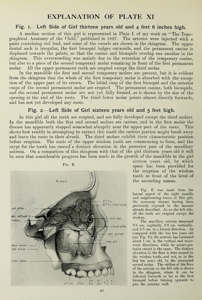 Fig. i.—Left Side of Girl thirteen years old and 4 feet 6 inches high. A median section of this girl is represented in Plate I. of my work on “ The Topo- graphical Anatomy of the Child,” published in 1887. The arteries were injected with a paint containing red lead, and some of the vessels are shown in the skiagram. The upper dental arch is irregular, the first bicuspid bulges outwards, and the permanent canine is displaced towards the palate, so that the canine and bicuspids overlap one another in the skiagram. This overcrowding was mainly due to the retention of the temporary canine, but also to a piece of the second temporary molar remaining in front of the first permanent molar. All the upper permanent teeth are erupted except the third molar. In the mandible the first and second temporary molars are present, but it is evident from the skiagram that the whole of the first temporary molar is absorbed with the excep- tion of the upper part of its crown. The labial cusp of the first bicuspid and the anterior cusps of the second permanent molar are erupted. The permanent canine, both bicuspids, and the second permanent molar are not yet fully formed, as is shown by the size of the opening at the end of the roots. The third lower molar points almost directly forwards, and has not yet developed any roots. Fig. 2.—Left Side of Girl sixteen years old and 5 feet high. In this girl all the teeth are erupted, and are fully developed except the third molars. In the mandible both the first and second molars are carious, and in the first molar the disease has apparently stopped somewhat abruptly near the upper part of the roots. This shows how readily in attempting to extract this tooth the carious portion might break away and leave the roots in their alveoli. The third molars exhibit their characteristic position before eruption. The roots of the upper wisdom tooth are commencing to form, and the crypt for the tooth has caused* a distinct elevation in the posterior part of the maxillary antrum. On a comparison of this skiagram with that of the girl thirteen years old it will be seen that considerable progress has been made in the growth of the mandible in the girl sixteen years old, by which space has been provided for the eruption of the wisdom tooth in front of the level of the ascending ramus. Fig. E was made from the lateral aspect of the right maxilla and neighbouring bones of this girl, the accessory sinuses having been previously exposed in the manner already described. As on the left side, all the teeth are erupted except the wisdom. The maxillary antrum measured 3-5 cm. sagittally, 3-0 cm. vertically, and 2’5 cm. in a lateral direction. As compared with the boy ten years old (see Fig. D), the antrum has increased about 1 cm. in the vertical and trans- verse directions, while its antero-pos- terior extent is the same. The distinct elevation in the floor is here caused by the wisdom tooth, and not, as in the boy ten years old, by the unerupted second molar. The outline of the floor of the antrum on the left side is shown in the skiagram, where it can be followed forwards as far as the first bicuspid before turning upwards to join the anterior wall. Fig. E. an! ebh asc cell supr m tnf-erm „ 3rd F.c.(fronI sinus) max luber pm ]lfprn bic bic. i l