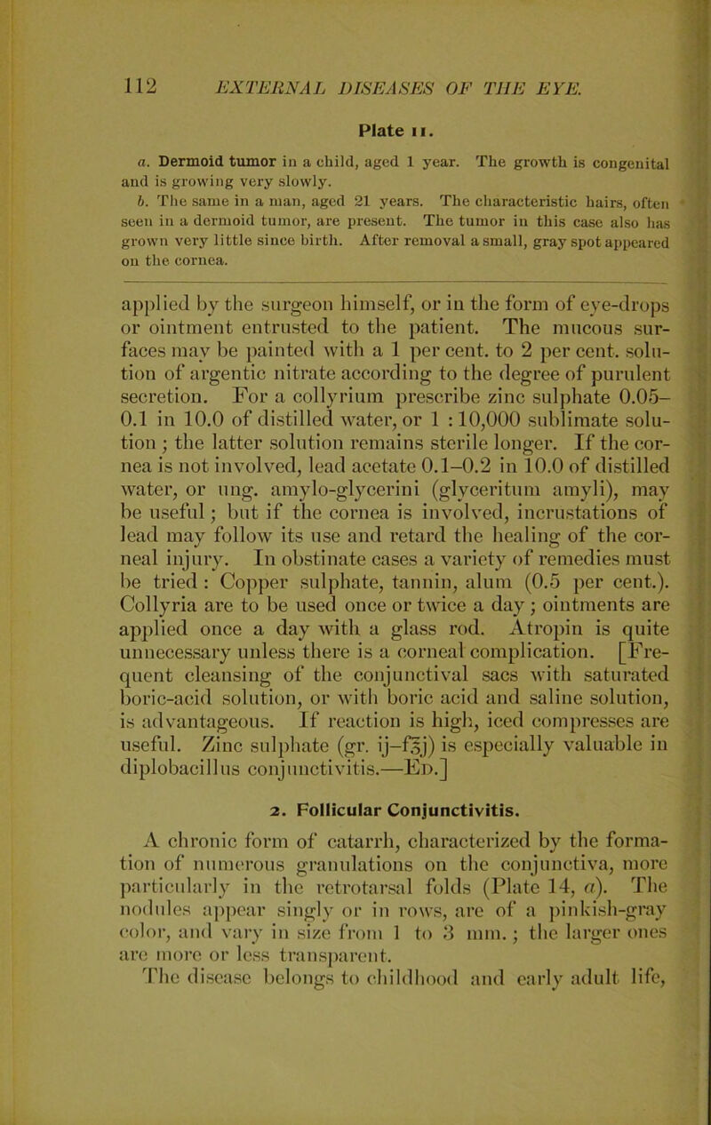 Plate 11. «. Dermoid tumor in a child, aged 1 year. The growth is congenital and is growing very slowly. b. The same in a man, aged 21 years. The characteristic hairs, often seen iii a dermoid tumor, are present. The tumor in this case also lias grown very little since birth. After removal a small, gray spotappeared on the cornea. applied by the surgeon himsclf, or iu the form of eye-drops or ointment entrusted to the patient. The mucous sur- faces mav be painted witli a 1 per cent. to 2 per cent. solu- tion of argentic nitrate according to the degree of purulent secretion. For a collyrium prescribe zinc sulphate 0.05- 0.1 in 10.0 of distilled water, or 1 :10,000 Sublimate Solu- tion ; the latter solution remains sterile longer. If the cor- nea is not involved, lead acetate 0.1-0.2 in 10.0 of distilled water, or ung. amylo-glycerini (glyceritum amyli), may be useful; but if the cornea is involved, incrustations of lead may follow its use and retard the healing of the cor- neal injury. In obstinate cases a variety of remedies must be tried : Copper sulphate, tannin, alum (0.5 per cent.). Collyria are to be used once or twice a day; ointments are applied once a day witli a glass rod. Atropin is quite unnecessary unless there is a corneal complication. [Fre- quent cleansing of the conjunctival sacs witli saturated boric-aeid solution, or witli boric acid and sahne solution, is advantageous. If reaction is high, iced compresses are useful. Zinc sulphate (gr. ij-fsj) is especially valuable in diplobacillus Conjunctivitis.—Ed.] 2. Follicular Conjunctivitis. A chronic form of catarrh, characterized by the forma- tion of numerous grannlations on the conjunctiva, more particularly in the retrotarsal folds (Plate 14, er.). The nodules appear singly or in rows, are of a pinkish-gray color, and vary in size froni 1 to 3 mm.; the larger ones arc more or less transparent. The disease belongs to childhood and early adult life,