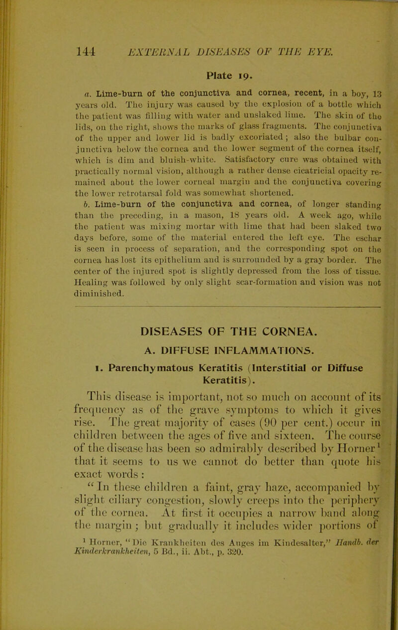 Plate 19. a. Lime-burn of the conjunctiva and cornea, recent, in a boy, 13 years old. The injury was caused by the explosiou of a bottle which the patient was tilling with water and uuslaked liuie. The skin of tho lids, 011 the riglit, shows the marks of glass fragiuents. The conjunctiva of the upper and lower lid is badly excoriated; also the bulbar con- junctiva below tlie cornea and the lower Segment of the cornea itself, which is dim and bluish-whitc. Satisfactory eure was obtaiued with practically normal vision, although a rather deuse cicatricial opacity re- mained about the lower eorueal margiu and the conjunctiva covering the lower retrotarsal fohl was somewhat shorteued. b. Lime-burn of the conjunctiva and cornea, of longer standing than the preceding, in a mason, 18 years old. A week ago, while the patient was mixing mortar with lime that liad been slaked two days before, some of the material entered the left eye. The eschar is seen in process of Separation, and the correspondiug spot on the cornea has lost its epithelium and is surrounded by a gray border. The center of the injured spot is sliglitly depressed from the loss of tissue. Healing was followed by only slight scar-formation and vision was not diminished. DISEASES OF THE CORNEA. A. DIFFUSE INFL AMMAT IONS. 1. Parenchymatous Keratitis (Interstitial or Diffuse Keratitis). This disease is important, not so much on account of its frequency as of the grave Symptoms to which it gives rise. The great majority of cases (90 per cent.) oeenr in cliildren between the ages of tive and sixteen. The course of the disease has been so admirably described by Horner1 that it seems to us we cannot do better than quote his exact words : “In these cliildren a faint, gray haze, accompanied by slight ciliary congestion, slowly creeps into the periphery of the cornea. At first it oeenpies a narrow band along the margin ; but gradually it includes wider portions of 1 Horner, “Die Krankheiten des Auges im Kindesalter,” llandb. der Kinderkrankheiten, 5 Hd., ii. Abt., p. 320.