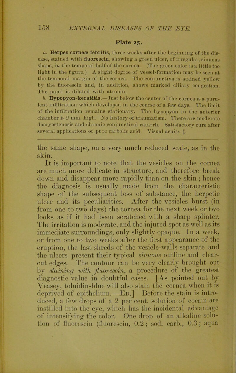 Plate 25. a. Herpes cornese febrilis, three weeks after tlie beginning of the dis- ease, stained with fluorescin, showing a green ulcer, of irregulär, sinuous shape, iu the temporal half of the cornea. (The green eolor is a little too light in the figure.) A slight degree of vessel-formation may be seen at the temporal margin of the cornea. The conjunctiva is stained yellow by the fluorescin and, in addition, shows marked ciliary congestion. The pupil is dilated with atropin. I). Hypopyon-keratitis. -Just below the center of the cornea is a puru- lent infiltration which developed in thecourseof a few days. Tlie limit of the infiltration remains stationary. The hypopyon in the anterior chamber is 2 mm. high. No history of traumatism. There are moderate dacryosteuosis and chronic conjunctival catarrh. Satisfactory eure after several applications of pure carbolic acid. Visual aeuity f. the same shape, ou a very much reduced scale, as in the skin. It is important to note that the vesicles on the cornea are much more delicate in structure, and therefore break down and disappear more rapidly than on tlie skin ; hence the diagnosis is usually made from the characteristic sliape of tlie subsequent loss of substance, the herpetic ulcer and its peculiarities. After the vesicles bürst (in from one to two days) the cornea for the next week or two looks as if it had been scratched with a sharp splinter. The irritation is moderate, and the in jured spot as well as its immediate surroundings, only slightly opaque. In a week, or from one to two weeks after the first appearance of tlie eruption, the last slireds of the vesicle-walls separate and the ulcers present their typical sinuous outline and clear- cut edges. The contour can be very clearly brought out bv staining with fluorescin, a procedure of the greatest diagnostic value in doubtful cases. [As pointed out by Veasey, toluidin-blue will also stain the cornea wlien it is deprived of epithelium.—Ed.] Before the stain is intro- duced, a few drops of a 2 per cent. solution of cocain are instilled into the eye, which has the incidental advantage of intensifying the eolor. One droj) of an alkaline solu- tion of fluorescin (fluorescin, 0.2; sod. carb., 0.3; aqua