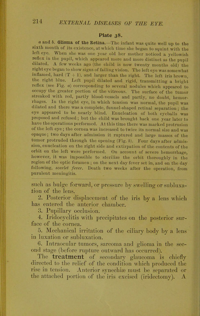 Plate 38. a aud b. Glioma of the Retina.—Tlie infant was quitc well up to the sixth month of its existence, at wliich time slie began to squint witk the left eye. When she was one year old her wotker notieed a yellowish reflex in the pupil, which appeared more aud more distinct as the pupil dilated. A few weeks ago (the child is now twenty montks old) the light eye began to sliow signs of failing Vision. The left eye was somewliat inflained, hard (T + 1), and larger than the right. The left iris brown, the right blue. Left pupil dilated and rigid, transmitting a briglit reflex (sec Fig. a) corresponding to several nodules which appeared to occupy the greater portion of the vitreous. The surface of the tumor streaked with red, partly blood-vessels and partly, no doubt, kernor- lliages. In the right eye, in which tension was normal, the pupil was dilated and there was a complete, fuunel-shaped retinal Separation ; the eye appeared to be nearly blind. Euucleation of both eyeballs was proposed and relused; but the child was brought back one year later to liave the operatious performed. At this time there was marked protrusion of the left eye; the coruea was increased to twice its normal size aud was opaque; two days after admission it ruptured and large masses of the tumor protruded through the opening (Fig. b). Four days after admis- sion, enucleation on the right side and extirpation of the contents of the orbit on the left were performed. Ou account of severe hemorrkage, however, it was impossible to sterilize the orbit thoroughly in the region of the optic forameu ; on the next day fever set in, and on the day following, scarlet fever. Death two weeks after the Operation, from purulent meningitis. such as btilge forward, or pressure by swelling or Subluxa- tion of the lens. 2. Posterior displacement of the iris by a lens which has entered the anterior chamber. 3. Pupillary occlusion. 4. Iridocyclitis with precipitates on the posterior sur- face of the coniea. 5. Mechanical irritation of the ciliary body by a lens in luxation or Subluxation. 6. Intraocular tu mors, sarcoma and glioma in the sec- ond stage (before rupture outward has occurred). The treatment of secondary glaucoma is chiefly directed to the relief of the condition which produced the rise in tension. Anterior synechite must be scparated or the attached portion of the iris excised (iridectomy). A