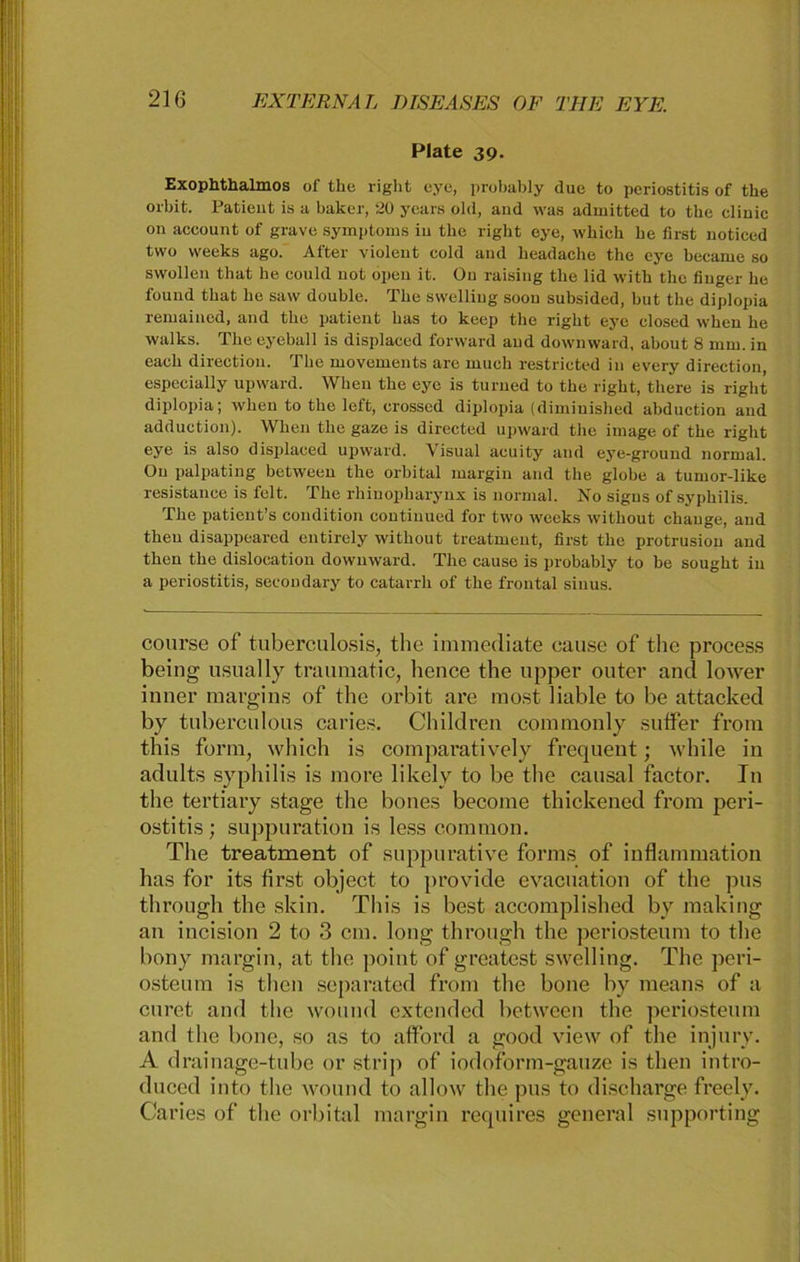 Plate 39. Exophthalmos of the right eye, probably due to periostitis of tbe orbit. Patient is a baker, 20 years old, and was admitted to the cliuic on aceount of grave Symptoms in tlie right eye, whieh be first noticed tvvo weeks ago. After violent cold and headache the eye became so swollen tliat he could not open it. On raising the lid with the finger he found that he saw double. The swelliug soon subsided, hut the diplopia remained, and the patient has to keep the right eye closed when he walks. The eyeball is displaced forward and downward, about 8 mm. in each direction. The movements are rnuch restricted in every direction, especially upward. When the eye is turned to the right, tliere is right diplopia; when to the left, crossed diplopia (diminished abduction and adduction). When the gaze is directed upward the image of the right eye is also displaced upward. Visual acuity and eye-ground normal. On palpating between the orbital margin and the globe a tumor-like resistance is feit. The rhinopharynx is normal. No signs of Syphilis. The patient’s condition contiuued for two weeks witliout chauge, and theu disappeared entirely without treatmeut, first the protrusion and then the dislocation downward. The cause is probably to be sought in a periostitis, secondary to catarrh of the frontal siuus. course of tuberculosis, the immediate cause of the process being usually traumatic, hence the upper outer and lower inner margins of the orbit are most liable to be attacked by tuberculous caries. Children commonly sutfer frora this form, which is comparatively frequent; while in adults Syphilis is more likely to be the causal factor. In the tertiary stage the bones become thickened front peri- ostitis ; suppuration is less contmon. The treatment of suppurative forms of inflammation has for its first object to provide evacuation of the pus through the skin. This is best accomplished by making an incision 2 to 3 cm. long through the periosteum to the bony margin, at the point of greatest swelling. The peri- osteum is then separated from the bone by means of a curet and the wound extended between the periosteum and the bone, so as to afford a good view of the injury. A d rainage-tube or strip of iodoform-gauze is then intro- duced into the wound to allow the pus to discharge freely. Caries of the orbital margin requires general supporting