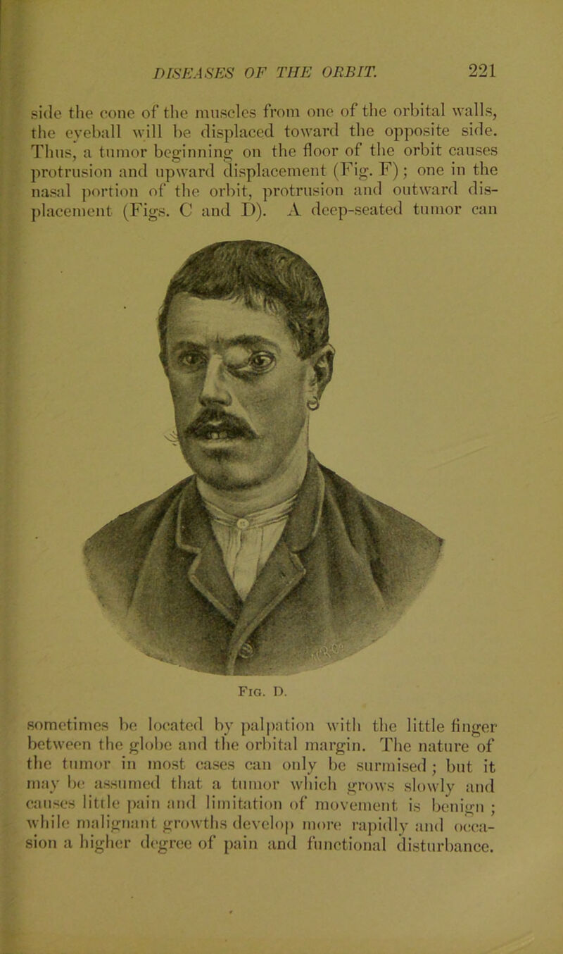 siele the cone of the museles from one of the orbital walls, the eyeball will be displaced towarcl the opposite side. Thus, a tumor beginning ou the floor of the orbit causes protrusion and upward displacement (Fig. F); one in the nasal portion of the orbit, protrusion and outward dis- placement (Figs. C and I>). A deep-seated tumor can Fig. D. sometimes be located hy palpation with the little finger between the globe and the orbital margin. Tlie nature of the tumor in inost cases can only be surmised ; but it may be assumed that a tumor which grovvs slowly and causes litrle pain and limitation of movement is benign ; while malignant growths develop more rapidly and oeca- sion a higher degree of pain and functional disturbance.
