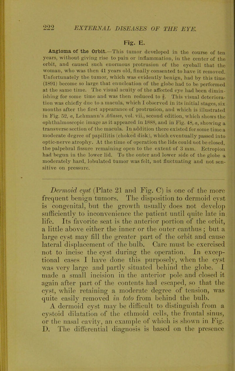Fig. E. Angioma of the Orbit.—TJiis tumor developed in tlie course of ten years, without giving rise to pain or inflammation, in the center of the orbit, and caused such enormous protrusiou of the eyeball that the woman, vvho was then 41 years old, finally consented to have it removed. Unfortuuately the tumor, which was evidently benign, had by this time (1891) become so large that enucleation of the globe had to be performed at the same time. The visual acuity of the aflected eye had been dimin- ishing for some time and was then reduced to 5. This visual deteriora- tion was chiefly due to a macula, which I observed in its initial stages, six months after the first appearance of protrusiou, and which is illustrated in Fig. 52, a, Lehmann’s Ätlases, vol. vii., sccoml edition, which shows the ophthalmoscopic image as it appeared in 1888, and in Fig. 48, a, showiug a transversesection of the macula. In addition there existed for some time a moderate degree of papillitis (choked disk), which eventually passed into optic-nerve atropliy. At the time of Operation the lids could not be closed, thepalpebral fissure remaining open to the extent of 3 mm. Ectropion had begun in the lower lid. To the outer and lower side of the globe a moderatcly hard, lobulated tumor was feit, not fluctuating and not sen- sitive on pressure. Dermoid cyst (Plate 21 and Fig. C) is one of the niore frequent benign tumors. The disposition to dermoid cyst is congenital, but the grovvth usually does not develop snfficiently to inconvenience the patient nntil quite late in life. Its favorite seat is the anterior portion of the orbit, a little above either the inner or the outer canthus; but a large cyst may fill the greater part of the orbit and cause lateral displacement of thebulb. Care must be exercised not to incise the cyst during the Operation. In excep- tional cases I have done this purposely, when the cyst was very large and partly situated behind the globe. I made a small incision in the anterior pole and closed it again after part of the contents had escaped, so that the cyst, while retaining a moderate degree of tension, was quite easily removed in toto from behind the bulb. A dermoid cyst may be difficult to distinguish from a cystoid dilatation of the ethmoid cells, the frontal sinus, or the nasal cavrty, an example of which is shown in Fig. D. The differential diagnosis is based on the presence