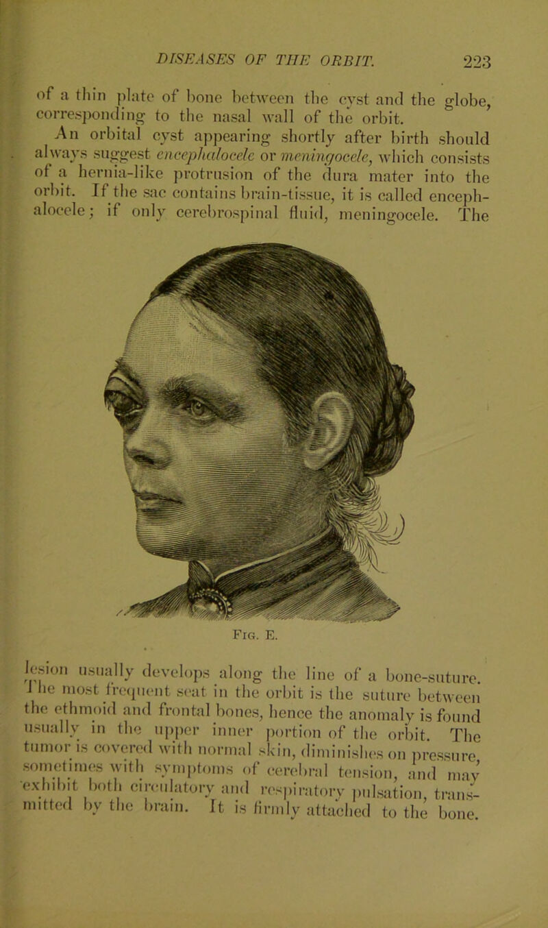 of a thin plate of bone between tlie cyst and the globe, corresponding to the nasal wall of the orbit. An orbital cyst appearing shortly after birth shonld always suggest encephalocele or meningocele, which consists of a hernia-like protrusion of the dura mater into the orbit. If the sac contains brain-tissue, it is called enceph- alocele; if only cerebrospinal fluid, meningocele. The Fig. e. lesioii usually develops along the line of a bone-suture. J he most frequent seat in the orbit is the suture between the ethmoid and frontal bones, hence the anomaly isfound usually in the upper inner portion of the orbit The tumor is covered with normal skin, diminishes on pressure sometimes with Symptoms of cerebral tension, and mav 'exhibit both ci reu lato ry and respiratory pulsation, trans- niitted by the bram. It is firmly attached to the bone.