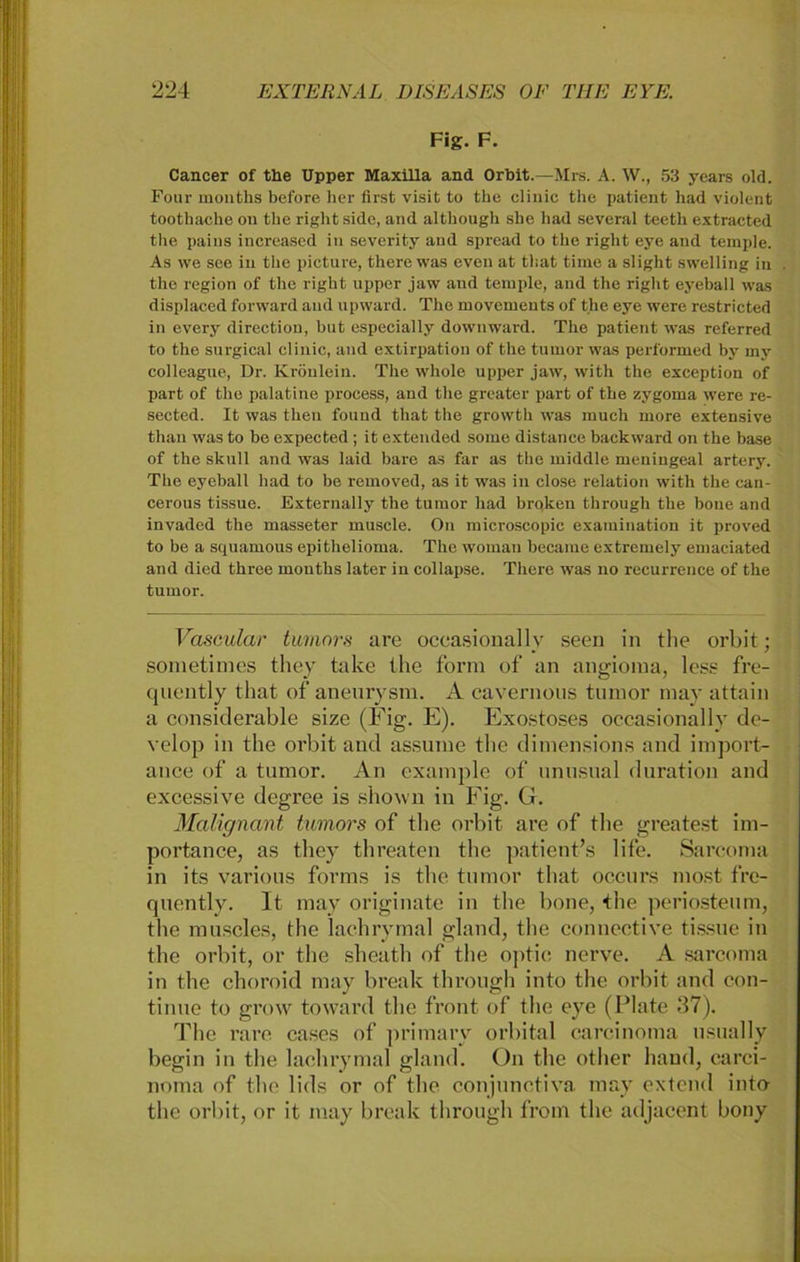 Fig. F. Cancer of the Upper Maxilla and Orbit.—Mrs. A. W., 53 years old. Four months before her first visit to the clinic the patient had violent toothache on the right side, and although she had several teeth extracted the pains increased in severity and spread to the right eye and temple. As we see in the pieture, there was eveu at that time a slight swelling in the region of the right upper jaw and temple, and the right eyeball was displaced forward and upward. The movemeuts of the eye were restricted in every direction, but especially down ward. The patient was referred to the surgical clinic, and extirpation of the tumor was performed by my eolleague, Dr. Krönlein. The whole upper jaw, with the exception of part of the palatine process, and the greater part of the zygoma were re- sected. It was then found that the growth was much more extensive than was to be expected ; it extended some distance backward on the base of the skull and was laid bare as far as the middle meningeal artery. The eyeball had to be removed, as it was in close relation wTith the can- cerous tissue. Externally the tumor had broken through the bone and invaded tlie masseter muscle. On microscopic examination it proved to be a squamous epithelioma. The wornan became extremely emaciated and died three months later in collapse. There was no recurrence of the tumor. Vascular tumor* are occasionally seen in the orbit; sometimes they take the form of an angioma, less fre- quently that of aneurysm. A cavernous tumor may attain a considerable size (Fig. E). Exostoses occasionally de- velop in the orbit and assume the dimensions and import- ance of a tumor. An example of unusual duration and excessive degree is shown in Fig. G. Malignant tumors of the orbit are of the greatest im- portance, as they threaten the patient’s life. Sarcoma in its various forms is the tumor that occurs inost fre- quently. It may originate in the bone, the periosteum, the muscles, the lachrymal gland, the connective tissue in the orbit, or the sheath of the optic nerve. A sarcoma in the choroid may break through into the orbit and con- tinue to grow toward the front of the eye (Plate 37). The rare cases of primarv orbital carcinoma usually begin in the lachrymal gland. On the other haud, carci- noma of the lids or of the conjunctiva may extend into the orbit, or it may break through from the adjacent bony