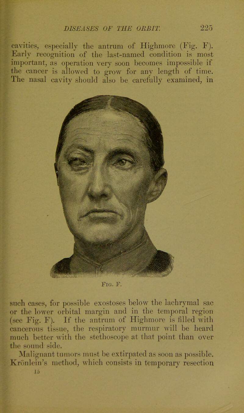 cavities, especially the antrum of Highmore (Fig. F). Early recognition of the last-named condition is most important, as Operation very soon becomes impossible if the cancer is allowed to grow for any length of time. The nasal cavity should also be carefully examined, in Fig. F. such cases, for possible exostoses below the laehrymal sac or the lower orbital margin and in the temporal region (see Fig. F). If the antrum of Highmore is filled witli cancerous tissue, the respiratory murmur will be heard much better witli the stethoscope at that point than over the souud side. Malignant tu mors must be extirpated as soon as possible. Krönlein’s method, which consists in temporary resection 15