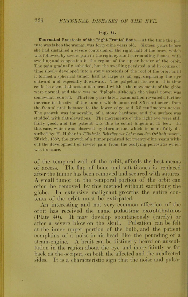 Fig. Q. Eburnated Exostosis of the Right Frontal Bone.—Al the time tlie pie- ture was taken tlie vornan was forty-nine years old. Sixteen years before she had snstained a severe contusion of the right half of the brow, whicli was followed by severe pain in the right eye and surrounding tissues, with swelling and congestion in the region of the upper border of the orbit. The pain gradually subsided, but the swelling persisted, and in eourse of time slowly developed iuto a stony exostosis of the roof of the orbit until it formed a splierical tumor half as large as au egg, displacing the eye outward and especially downward. The palpebral fissure at this time could be opened almost to its normal widtli; the movements of the globe were normal, and tliere was no diplopia, althougli the visyal power was somcwhat reduccd. Thirteen years later, examination revealed a further increase in the size of the tumor, wliich measured 8.5 centimeters from the frontal protuberance to the lower edge, and 5.5 centimeters across. The growtli was immovable, of a stony liardness, and the surface was studded with flat elevations. The movements of the right eye were still fairly good, and the patient was able to count Angers at 15 feet. In this case, which was observed by Horner, and wliicli is more fnlly de- scribed by H. Huber in Klinische Beiträge zur Lehrevon den Orbitaltimorcn, Zürich, 1882, the growth of a tumor persisted for twenty-nine years witli- out tlie development of severe pain from the ossifyiug periostitis which was its cause. of tlie temporal wall of tlie orbit, alfords tlie best means of access. The flap of bone and soft tissues is replaced after tlie tumor lias beeil removed and secured with sutures. A small tumor in tlie temporal portion of the orbit can often be removed by this metliod without sacrifieing the srlobe. In extensive maliemant growths the entire con- tents of the orbit must be extirpated. An interesting and not very common alfection of tlie orbit lias received tlie name pulsating exophthalmos (Plate 40). It may develop spontaneously (rarely) or after a severe blow on the skull. Pulsation can be feit at the inner upper portion of the bulb, and tlie patient complains of a noise in bis head like tlie pounding of a steam-engine. A bruit can be distinctly heard on ausoul- tation in tlie region about tlie eye and more faintly as far back as tlie occiput, on botli the affected and tlie unaffeeted sides. It is a eharacteristic sign that tlie noise and pulsa-