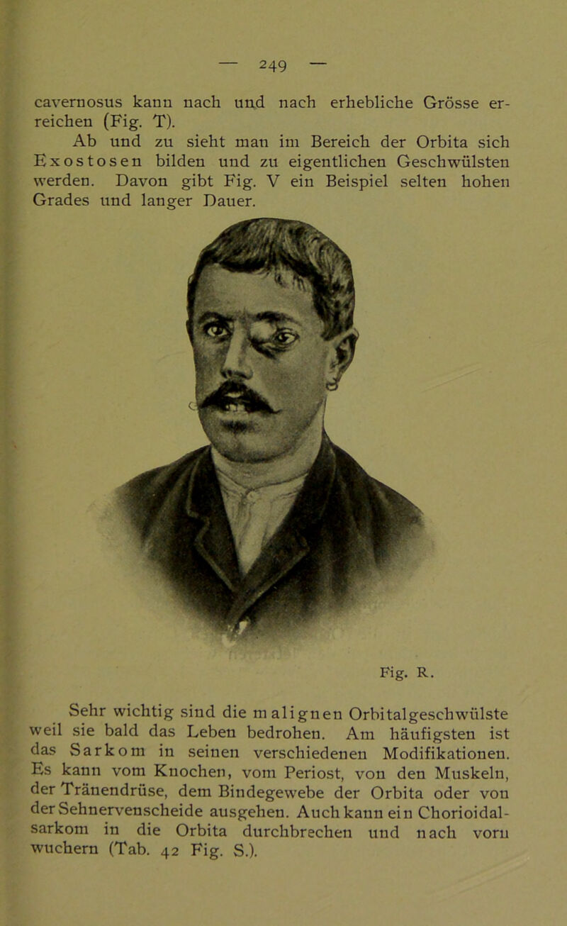 cavernosus kann nach und nach erhebliche Grösse er- reichen (Fig. T). Ab und zu sieht man im Bereich der Orbita sich Exostosen bilden und zu eigentlichen Geschwülsten werden. Davon gibt Fig. V ein Beispiel selten hohen Grades und langer Dauer. Fig. R. Sehr wichtig sind die malignen Orbitalgeschwülste weil sie bald das Leben bedrohen. Am häufigsten ist das Sarkom in seinen verschiedenen Modifikationen. Es kann vom Knochen, vom Periost, von den Muskeln, der Tränendrüse, dem Bindegewebe der Orbita oder von der Sehnervenscheide ausgehen. Auch kann ein Chorioidal- sarkom in die Orbita durchbrechen und nach vorn wuchern (Tab. 42 Fig. S.).