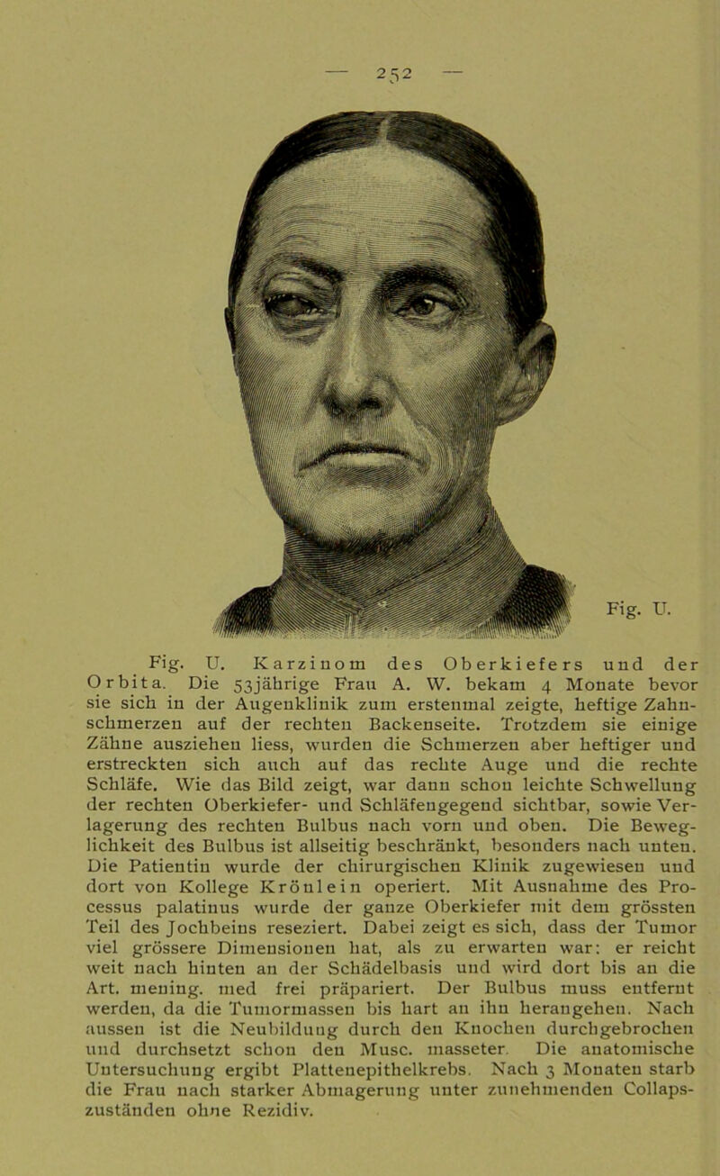 Fig. U. Karzinom des Oberkiefers und der Orbita. Die 53jährige Frau A. W. bekam 4 Monate bevor sie sich in der Augenklinik zum erstenmal zeigte, heftige Zahn- schmerzen auf der rechten Backenseite. Trotzdem sie einige Zähne ausziehen Hess, wurden die Schmerzen aber heftiger und erstreckten sich auch auf das rechte Auge und die rechte Schläfe. Wie das Bild zeigt, war dann schon leichte Schwellung der rechten Oberkiefer- und Schläfengegend sichtbar, sowie Ver- lagerung des rechten Bulbus nach vorn und oben. Die Beweg- lichkeit des Bulbus ist allseitig beschränkt, besonders nach unten. Die Patientin wurde der chirurgischen Klinik zugewiesen und dort von Kollege Krönlein operiert. Mit Ausnahme des Pro- cessus palatinus wurde der ganze Oberkiefer mit dem grössten Teil des Jochbeins reseziert. Dabei zeigt es sich, dass der Tumor viel grössere Dimensionen hat, als zu erwarten war: er reicht weit nach hinten an der Schädelbasis und wird dort bis an die Art. mening. med frei präpariert. Der Bulbus muss entfernt werden, da die Tumormassen bis hart an ihn herangehen. Nach aussen ist die Neubildung durch den Knochen durch gebrochen und durchsetzt schon den Muse, masseter. Die anatomische Untersuchung ergibt Plattenepithelkrebs. Nach 3 Monaten starb die Frau nach starker Abmagerung unter zunehmenden Collaps- zuständen ohne Rezidiv.
