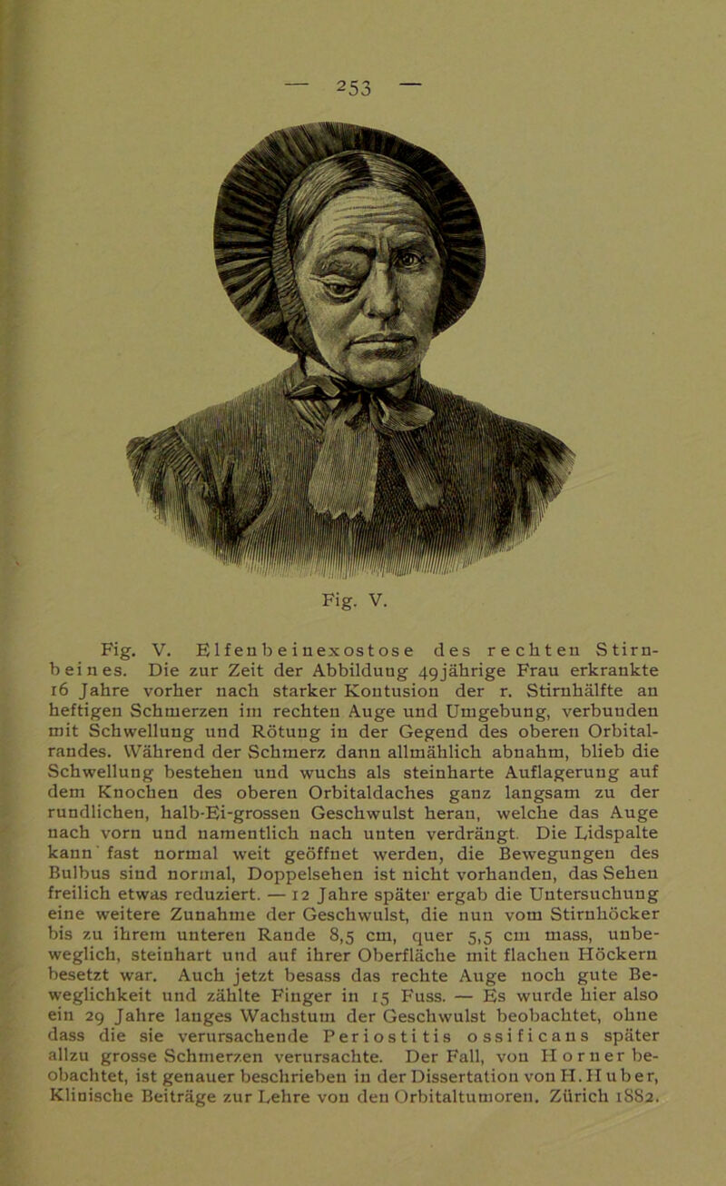 Fig. V. Elfenbeinexostose des rechten Stirn- beines. Die zur Zeit der Abbildung 49jährige Frau erkrankte 16 Jahre vorher nach starker Kontusion der r. Stirnhälfte an heftigen Schmerzen im rechten Auge und Umgebung, verbunden mit Schwellung und Rötung in der Gegend des oberen Orbital- randes. Während der Schmerz dann allmählich abnahm, blieb die Schwellung bestehen und wuchs als steinharte Auflagerung auf dem Knochen des oberen Orbitaldaches ganz langsam zu der rundlichen, halb-Ei-grossen Geschwulst heran, welche das Auge nach vorn und namentlich nach unten verdrängt. Die Uidspalte kann' fast normal weit geöffnet werden, die Bewegungen des Bulbus sind normal, Doppelsehen ist nicht vorhanden, das Sehen freilich etwas reduziert. — 12 Jahre später ergab die Untersuchung eine weitere Zunahme der Geschwulst, die nun vom Stirnhöcker bis zu ihrem unteren Rande 8,5 cm, quer 5,5 cm mass, unbe- weglich, steiuhart und auf ihrer Oberfläche mit flachen Höckern besetzt war. Auch jetzt besass das rechte Auge noch gute Be- weglichkeit und zählte Finger in 15 Fuss. — Es wurde hier also ein 29 Jahre langes Wachstum der Geschwulst beobachtet, ohne dass die sie verursachende Periostitis ossificans später allzu grosse Schmerzen verursachte. Der Fall, von Horner be- obachtet, ist genauer beschrieben in der Dissertation von H. Hub er, Klinische Beiträge zur Lehre von den Orbitaltumoren. Zürich 1SS2.
