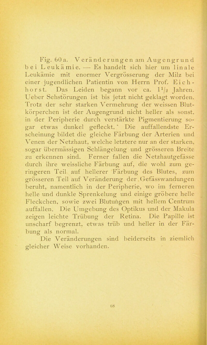 Fig. 60a. Veränderungen am Augengrund bei Leukämie. — Es handelt sich hier um linale Leukämie mit enormer Vergrösserung der Milz bei einer jugendlichen Patientin von Herrn Prof. Eich- hörst. Das Leiden begann vor ca. D/2 Jahren. Ueber Sehstörungen ist bis jetzt nicht geklagt worden. Trotz der sehr starken Vermehrung der weissen Blut- körperchen ist der Augengrund nicht heller als sonst, in der Peripherie durch verstärkte Pigmentierung so- gar etwas dunkel gefleckt. * Die auffallendste Er- scheinung bildet die gleiche Färbung der Arterien und Venen der Netzhaut, welche letztere nur an der starken, sogar übermässigen Schlängelung und grösseren Breite zu erkennen sind. Ferner fallen die Netzhautgefässe durch ihre weissliche Färbung auf, die wohl zum ge- ringeren Teil auf hellerer Färbung des Blutes, zum grösseren Teil auf Veränderung der Gefässwandungen beruht, namentlich in der Peripherie, wo im ferneren helle und dunkle Sprenlcelung und einige gröbere helle Fleckchen, sowie zwei Blutungen mit hellem Centrum auffallen. Die Umgebung des Optikus und der Makula zeigen leichte Trübung der Retina. Die Papille ist unscharf begrenzt, etwas trüb und heller in der Fär- bung als normal. Die Veränderungen sind beiderseits in ziemlich gleicher Weise vorhanden. 68