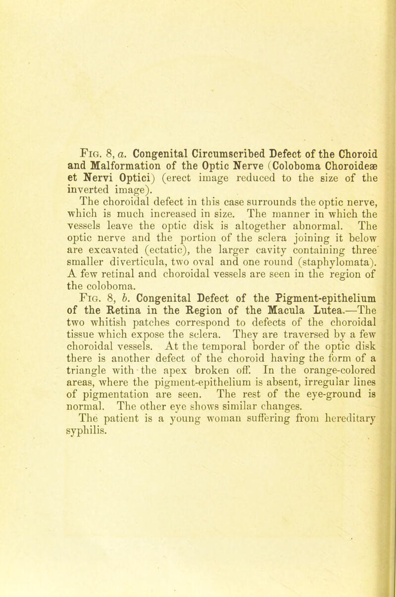 Fig. 8, a. Congenital Circumscribed Defect of the Choroid and Malformation of the Optic Nerve (Coloboma Choroide® et Nervi Optici) (erect ixnage reduced to the size of the inverted image). The choroidal defect in this case surrounds the optic nerve, which is much increased in size. The rnanner in which the vessels leave the optic disk is altogether abnormal. The optic nerve and the portion of the sclera joining it below are excavated (ectatic), the larger cavity containing three’ smaller diverticula, two oval and one round (staphylomata). A few retinal and choroidal vessels are seen in the region of the coloboma. Fig. 8, b. Congenital Defect of the Pigment-epithelium of the Retina in the Region of the Macula Lutea.—The two whitish patches correspond to defects of the choroidal tissue which expose the sclera. They are traversed by a few choroidal vessels. At the temporal border of the optic disk there is another defect of the choroid having the form of a triangle with the apex broken off. In the orange-colored areas, where the pigment-epithelium is absent, irregulär liues of pigmentation are seen. The rest of the eye-ground is normal. The otlier eye shows similar changes. The patient is a young woman suffering from liereditary Syphilis.