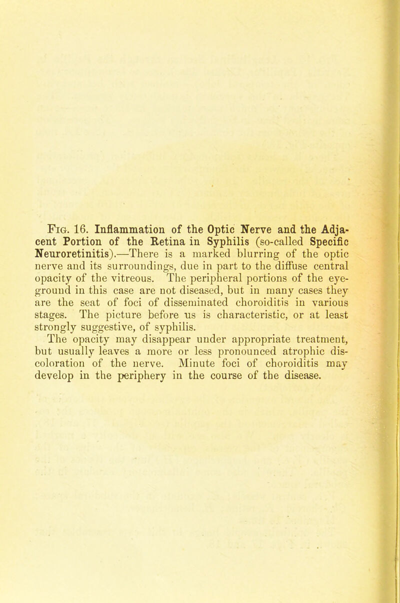 cent Portion of the Retina in Syphilis (so-called Specific Neuroretinitis).—There is a marked blurring of the optic nerve and its surroundings, due in part to the diffuse central opacity of the vitreous. The peripheral portions of the eye- grouud in this case are not diseased, but in many cases they are the seat of foci of disseminated choroiditis in various stages. The picture before ns is characteristic, or at least strongly suggestive, of Syphilis. The opacity may disappear under appropriate treatment, but usually leaves a more or less pronounced atrophic dis- coloration of the nerve. Minute foci of choroiditis may develop in the periphery in the course of the disease.