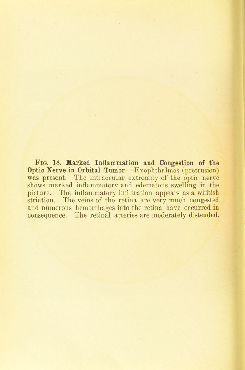Optic Nerve in Orbital Tumor.—Exophthalraos (protrusion) was present. The intraocular extremity of the optic nerve shows marked inflammatory and edematous swelling in the picture. The inflammatory infiltration appears as a whitish striation. The veins of the retina are very much congested and numerous hemorrhages into the retina have occurred in consequence. The retinal arteries are moderately distended.