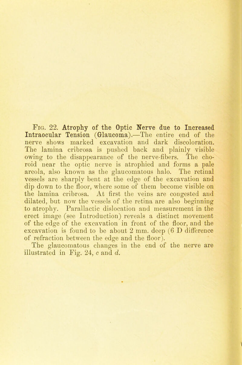 Intraocular Tension (Glaucoma).—The entire end of the nerve shovvs marked excavation and dark discoloration. The lamina cribrosa is pushed back and plainly visible owing to the disappearance of the nerve-fibers. The cho- roid near the optic nerve is atrophied and forms a pale areola, also knovvn as the glaucomatous halo. The retinal vessels are sharply bent at the edge of the excavation and dip down to the lioor, where some of thera become visible on the lamina cribrosa. At first the veins are congested and dilated, but now the vessels of the retina are also beginning to atrophy. Parallactic dislocation and measurement in the erect image (see Introduction) reveals a distinct movement of the edge of the excavation in front of the floor, and the excavation is found to be about 2 mm. deep (6 D difference of refraction between the edge and the floor). The glaucomatous changes in the end of the nerve are illustrated in Fig. 24, c and d.