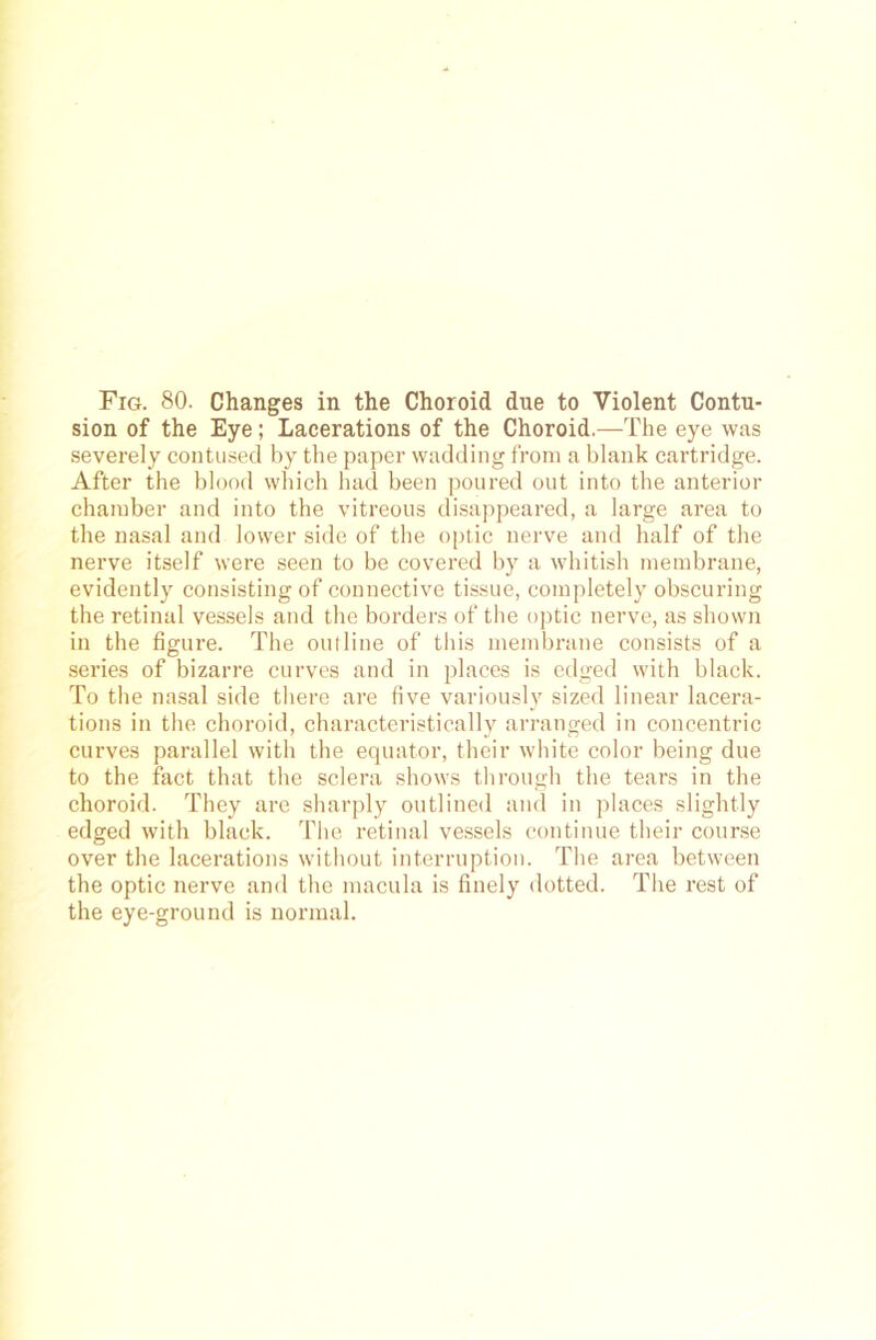 sion of the Eye; Lacerations of the Choroid.—The eye was severely contused by the paper wadding frotn a blank cartridge. After the blood which had been poured out into the anterior chamber and into the vitreous disappeared, a large area to the nasal and lower side of the optic nerve and half of the nerve itself were seen to be covered by a whitish metnbrane, evidently consisting of conuective tissue, completely obscuring the retinal vessels and the borders of the optic nerve, as shown in the figure. The outline of this membrane consists of a series of bizarre curves and in places is edged with black. To the nasal side tliere are five variously sized linear lacera- tions in the choroid, characteristically arranged in concentric curves parallel with the equator, their white color being due to the fact that the sclera shows through the tears in the choroid. They are sharply outlined and in places slightly edged with black. The retinal vessels continue their course over the lacerations without interruption. The area between the optic nerve and the macula is finely dotted. The rest of the eye-ground is normal.