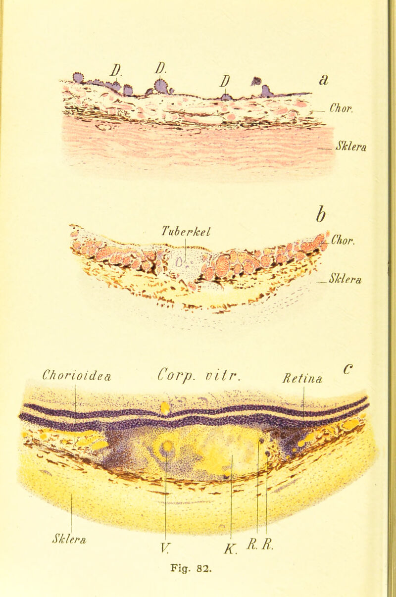 b Chor. _Sklera Sklera,