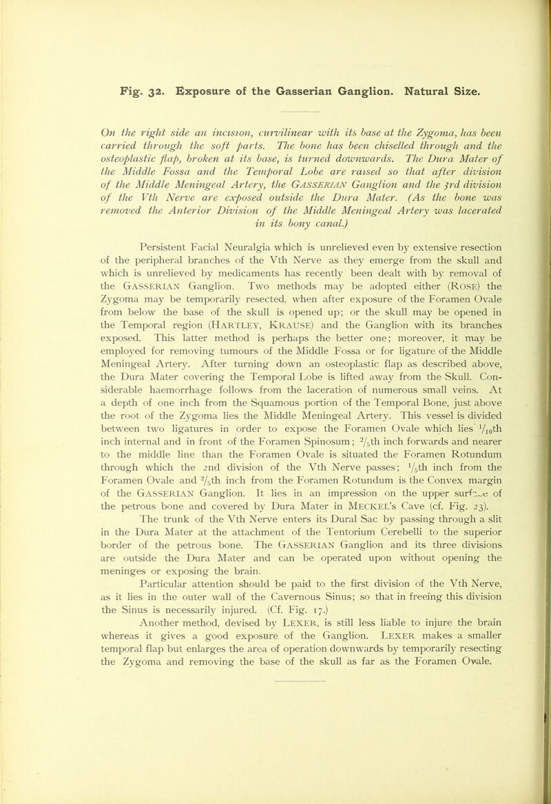 On the right side an incision, curvilinear with its base at the Zygoma, has been carried through the soft parts. The bone has been chiselled through and the osteoplastic flap, broken at its base, is turned downwards. The Dura Mater of the Middle Fossa and the Temporal Lobe are raised so that after division of the Middle Meningeal Artery, the Gasserian Ganglion and the 3rd division of the Vth Nerve are exposed outside the Dura Mater. (As the bone was removed the Anterior Division of the Middle Meningeal Artery was lacerated in its bony canal.) Persistent Facial Neuralgia which is unrelieved even by extensive resection of the peripheral branches of the Vth Nerve as they emerge from the skull and which is unrelieved by medicaments has recently been dealt with by removal of the GASSERIAN Ganglion. Two methods may be adopted either (Rose) the Zygoma may be temporarily resected, when after exposure of the Foramen Ovale from below the base of the skull is opened up; or the skull may be opened in the Temporal region (Hartley, Krause) and the Ganglion with its branches exposed. This latter method is perhaps the better one; moreover, it may be employed for removing tumours of the Middle Fossa or for ligature of the Middle Meningeal Artery. After turning down an osteoplastic flap as described above, the Dura Mater covering the Temporal Lobe is lifted away from the Skull. Con- siderable haemorrhage follows from the laceration of numerous small veins. At a depth of one inch from the Squamous portion of the Temporal Bone, just above the root of the Zygoma lies the Middle Meningeal Artery. This vessel is divided between two ligatures in order to expose the Foramen Ovale which lies Vioth inch internal and in front of the Foramen Spinosum; 2/5th inch forwards and nearer to the middle line than the Foramen Ovale is situated the Foramen Rotundum through which the 2nd division of the Vth Nerve passes; Y5th inch from the Foramen Ovale and 2/5th inch from the Foramen Rotundum is the Convex margin of the GASSERIAN Ganglion. It lies in an impression on the upper surface of the petrous bone and covered by Dura Mater in Meckel’s Cave (cf. Fig. 23). The trunk of the Vth Nerve enters its Dural Sac by passing through a slit in the Dura Mater at the attachment of the Tentorium Cerebelli to the superior border of the petrous bone. The Gasserian Ganglion and its three divisions are outside the Dura Mater and can be operated upon without opening the meninges or exposing the brain. Particular attention should be paid to the first division of the Vth Nerve, as it lies in the outer wall of the Cavernous Sinus; so that in freeing this division the Sinus is necessarily injured. (Cf. Fig. 17.) Another method, devised by LEXER, is still less liable to injure the brain whereas it gives a good exposure of the Ganglion. Lexer makes a smaller temporal flap but enlarges the area of operation downwards by temporarily resecting the Zygoma and removing the base of the skull as far as the Foramen Ovale.