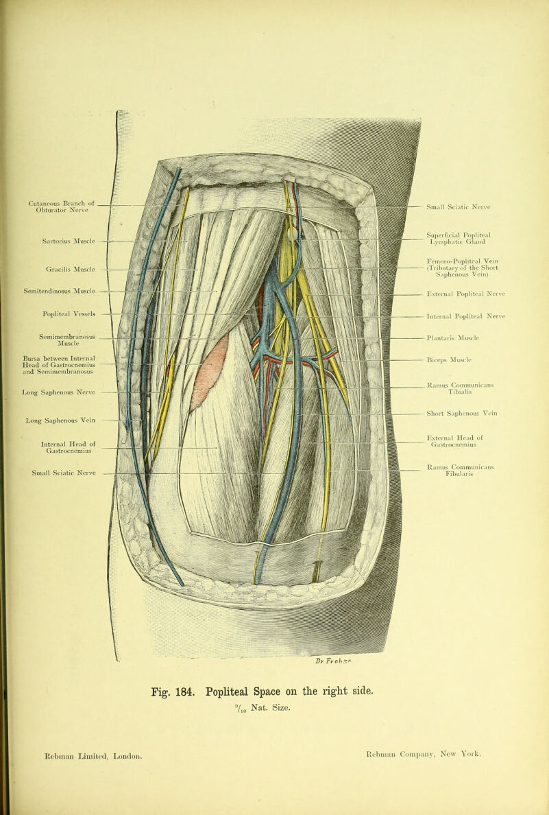 Cutaneous Branch of Obturator Nerve Sartorius Muscle Gracilis Muscle Semitendinosus Muscie Popliteal Vessels Semimembranosus Muscle Bursa between Internal Head of Gastrocnemius and Semimembranosus Long Saphenous Nerve Long Saphenous Vein Internal Head of Gastrocnemius Small Sciatic Nerve Dy Frohs” Small Sciatic Nerve Superficial Popliteal Lymphatic Gland Femoro-Popliteal Vein (Tributary of the Short Saphenous Vein) External Popliteal Nerve Internal Popliteal Nerve Plantaris Muscle Biceps Muscle Ramus Communicans Tibialis Short Saphenous Vein External Head of Gastrocnemius Ramus Communicans Fibularis Fig. 184. Popliteal Space on the right side. IJ/10 Nat. Size.