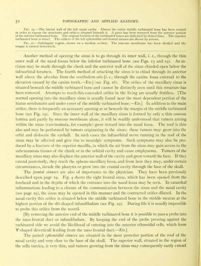 Fig. 19.—The lateral wall of the left nasal cavity. Almost the entire middle turbinated bone has been excised in order to expose the structures and orifices situated beneath it. A piece has been removed from the anterior portion of the inferior turbinated bone. The original borders of the turbinated bones are indicated by dotted lines. The superior turbinated bone is intact. The orifices of the left sphenoidal and frontal sinuses are shown by arrows. Fig. 20.—Sublingual region, shown on a median section. The mucous membrane has been divided and the tongue is turned downward. Another method of opening the sinus is to go through its inner wall, i. e., through the thin outer wall of the nasal fossas below the inferior turbinated bone (see Figs. 15 and 19). An in- cision may be made through the cheek and the anterior wall of the sinus chiseled open below the infraorbital foramen. The fourth method of attacking the sinus is to chisel through its anterior wall above the alveolus from the vestibulum oris [i. e., through the canine fossa external to the elevation caused by the canine tooth.—Ed.] (see Fig. 16). The orifice of the maxillary sinus is situated beneath the middle turbinated bone and cannot be distinctly seen until this structure has been removed. Attempts to reach this concealed orifice in the living are usually fruitless. [The normal opening into the maxillary sinus is usually found near the most dependent portion of the hiatus semilunaris and under cover of the middle turbinated bone.—Ed.] In addition to the main orifice, there is frequently an accessory opening at or beneath the margin of the middle turbinated bone (see Fig. 19). Since the inner wall of the maxillary sinus is formed by only a thin osseous lamina and partly by mucous membrane alone, it will be readily understood that tumors arising within the sinus (carcinomata, for example) grow inward into the nasal fossa. The roof is thin also and may be perforated by tumors originating in the sinus; these tumors may grow into the orbit and dislocate the eyeball. In such cases the infraorbital nerve running in the roof of the sinus may be affected and give rise to neuralgic symptoms. Such symptoms may also be pro- duced by a fracture of the superior maxilla, in which the air from the sinus may gain access to the subcutaneous tissues of the cheek or to the orbital cavity and cause emphysema. Tumors of the maxillary sinus may also displace the anterior wall of the cavity and grow toward the face. If they extend posteriorly, they reach the spheno-maxillary fossa, and from here they may, under certain circumstances, invade the pharynx or grow into the cranial cavity through the base of the skull. The frontal sinuses are also of importance to the physician. They have been previously described upon page 19. Fig. 4 shows the right frontal sinus, which has been opened from the forehead and in the depths of which the entrance into the nasal fossa may be seen. In catarrhal inflammations leading to a closure of the communication between the sinus and the nasal cavity (see page 19), the sinus may be opened in this manner and the contracted orifice dilated. In the nasal cavity this orifice is situated below the middle turbinated bone in the middle meatus at the highest portion of the slit-shaped infundibulum (see Fig. 19). During life it is usually impossible to probe this orifice from the nostril. [By removing the anterior end of the middle turbinated bone it is possible to pass a probe into the naso-frontal duct or infundibulum. By keeping the end of the probe pressing against the turbinated side we avoid the likelihood of entering into the anterior ethmoidal cells, which form Y-shaped diverticuli leading from the naso-frontal duct.—Ed.] The paired sphenoidal sinuses are situated in the most posterior portion of the roof of the nasal cavity and very close to the base of the skull. The superior wall, situated in the region of the sella turcica, is very thin, and tumors growing from the sinus may consequently easily extend