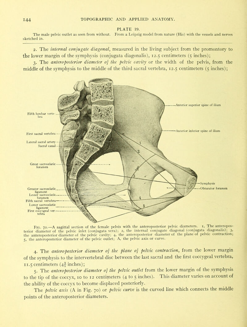 PLATE 19. The male pelvic outlet as seen from without. From a Leipzig model from nature (His) with the vessels and nerves sketched in. 2. The internal conjugate diagonal, measured in the living subject from the promontory to the lower margin of the symphysis (conjugata diagonalis), 12.5 centimeters (5 inches); 3. The anteroposterior diameter of the pelvic cavity or the width of the pelvis, from the middle of the symphysis to the middle of the third sacral vertebra, 12.5 centimeters (5 inches); Fig. 70.—A sagittal section of the female pelvis with the anteroposterior pelvic diameters. 1, The anteropos- terior diameter of the pelvic inlet (conjugata vera); 2, the internal conjugate diagonal (conjugata diagonalis); 3, the anteroposterior diameter of the pelvic cavity; 4, the anteroposterior diameter of the plane of pelvic contraction; 5, the anteroposterior diameter of the pelvic outlet; A, the pelvic axis or curve. 4. The anteroposterior diameter of the plane of pelvic contraction, from the lower margin of the symphysis to the intervertebral disc between the last sacral and the first coccygeal vertebra, 11.5 centimeters (4§- inches); 5. The anteroposterior diameter 0} the pelvic outlet from the lower margin of the symphysis to the tip of the coccyx, 10 to 12 centimeters (4 to 5 inches). This diameter varies on account of the ability of the coccyx to become displaced posteriorly. The pelvic axis (A in Fig. 70) or pelvic curve is the curved line which connects the middle points of the anteroposterior diameters. •Anterior superior spine of ilium Fifth lumbar verte- bra First sacral vertebra Lateral sacral inferior spine of ilium Lower sacrosciatic ligament First coccygeal ver- tebra