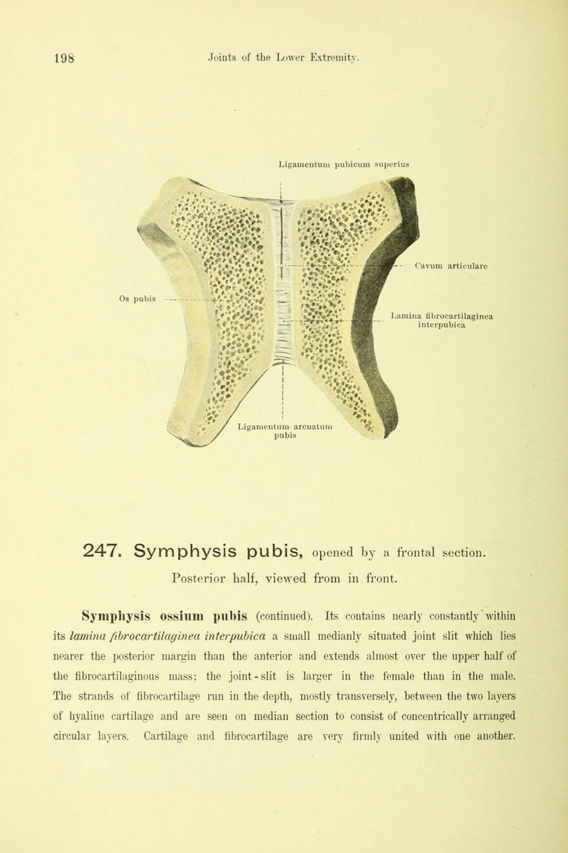 Ligamentuui pubicum sujjerius Os pubis -- Cavum articulare Lamina fibrocartilaginea interpubiea 247. Symphysis pubis, opened by a frontal section. Posterior half, viewed from in front. Symphysis OSSium puhis (continued). Its contains nearly constantly' within its lamina fibrocartilaginea interpubiea a small medianly situated joint slit which lies nearer the posterior margin than the anterior and extends almost over the upper half of the fibrocartilaginous mass; the joint-slit is larger in the female than in the male. The strands of fibrocartilage run in the depth, mostly transversely, between the two layers of hyaline cartilage and are seen on median section to consist of concentrically arranged circular layers. Cartilage and fibrocartilage are very firmly united with one another.