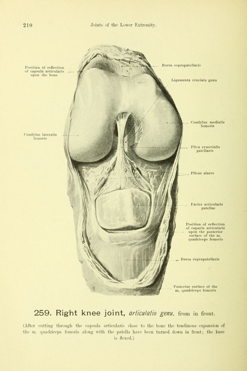 Plicae alares Position of reflection of capsnla articularis upon the posterior surface of the m. quadriceps femoris Bursa snprapatellaris Posterior surface of the m. quadriceps femoris Bursa suprapatellar is Ligamenta cruciata genu Condylus lateralis femoris Condylus medialis femoris Plica synovialis patellaris Facies articularis patellae Position of reflection of capsula articularis upon the bone 259. Right knee joint, articulatio genu, from in front. (After cutting through the capsnla articularis close to the bone the tendinous expansion of the m. cptadriceps femoris along with the patella have been turned down in front; the knee is flexed.)