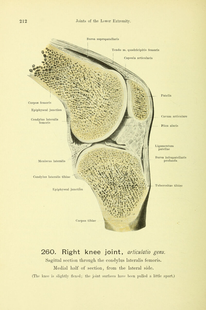 Bursa suprapatellaris Corpus femoris Epiphyseal junction Condylus lateralis femoris Tendo m. quadricipitis femoris Capsula articularis Patella Cavum articulare Plica alaris Corpus tibiae Meniscus lateralis Condylus lateralis tibiae Epiphyseal junction Ligamentum patellae Bursa infrapatellaris profunda Tuberositas tibiae 260. Right knee joint, articulatio genu. Sagittal section through the condylus lateralis femoris. Medial half of section, from the lateral side. (The knee is slightly flexed; the joint surfaces have been pulled a little apart.)