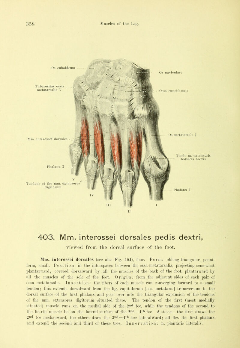 Mm. interossei dorsales Phalanx I Os metatarsale I Tendo m. extensoris hallncis brevis Y Tendons of the mm. extensores digitorum Os cuboideum Tuberositas ossis metatarsalis Y Ossa euneiformia Phalanx I Os naviculare 403. Mm. interossei dorsales pedis dextri, viewed from the dorsal surface of the foot. Mm. interossei dorsales (see also Fig. 404), four. Form: oblong-triangular, penni- form, small. Position: in the interspaces between the ossa metatarsalia, projecting somewhat plantar ward; covered dorsalward by all the muscles of the back of the foot, plantarwrard by all the muscles of the sole of the foot. Origin: from the adjacent sides of each pair of ossa metatarsalia. Insertion: the fibers of each muscle run converging forward to a small tendon; this extends dorsalward from the lig. capitulorum [oss. metatars.] transversum to the dorsal surface of the first phalanx and goes over into the triangular expansion of the tendons of the mm. extensores digitorum situated there. The tendon of the first (most medially situated) muscle rims on the medial side of the 2nd toe, while the tendons of the second to the fourth muscle lie on the lateral surface of the 2nd—4th toe. Action: the first draws the 2nd toe medianward, the others draw the 2nd—4th toe lateralward; all flex the first phalanx and extend the second and third of these toes. Innervation: n. plantaris lateralis.