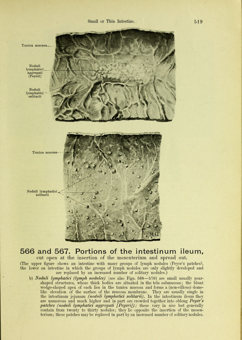 Tunica mucosa Noduli lymphatici aggregati [Peyeri] Noduli lymphatici solitarii Tunica mucosa-- Noduli lymphatici^: solitarii 566 and 567. Portions of the intestinum ileum, cut open at the insertion of the mesenterium and spread out. (The upper figure shows an intestine with many groups of lymph nodules (Peyer’s patches), the lower an intestine in which the groups of lymph nodules are only slightly developed and are replaced hy an increased number of solitary nodules.) b) Moduli lymphatici (lymph nodules) (see also Figs. 568—570) are small usually pear- shaped structures, whose thick bodies are situated in the tela submucosa; the blunt wedge-shaped apex of each lies in the tunica mucosa and forms a (non-villous) dome- like elevation of the surface of the mucous membrane. They are usually single in the intestinum jejunum (noduli lymphatici solitarii). In the intestinum ileum they are numerous and much higher and in part are crowded together into oblong Peyer's patches (noduli lymphatici aggregati [Peyeri]); these vary in size but generally contain from twenty to thirty nodules; they lie opposite the insertion of the mesen- terium; these patches maybe replaced in part by an increased number of solitary nodules.