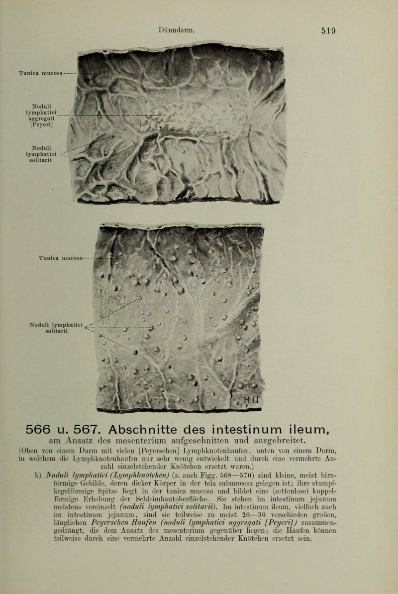 Tunica mucosa Noduli lympliatici aggregati [Peyeri] Noduli lymphatici solitarii Tunica mucosa-- Noduli lymphatici solitarii 566 u. 567. Abschnitte des intestinum ileum, am Ansatz des mesenterium aufgeschnitten und ausgebreitet. (Oben von einem Darin mit vielen [Peyerschen] Lymphknotenhaufen, unten von einem Darm, in welchem die Lymphknotenhaufen nur sehr wenig entwickelt und durch eine vermehrte An- zahl einzelstehender Knötchen ersetzt waren.) b) Noduli lymphatici (Lymphknötchen) (s. auch Figg. 568—570) sind kleine, meist bim- förmige Gebilde, deren dicker Körper in der tela submucosa gelegen ist; ihre stumpf- kegelförmige Spitze liegt in der tunica mucosa und bildet eine (zottenlose) kuppel- förmige Erhebung der Schleimhautoberfläche. Sie stehen im intestinum jejunum meistens vereinzelt (noduli lymphatici solitarii). Im intestinum ileum, vielfach auch im intestinum jejunum, sind sie teilweise zu meist 20—30 verschieden großen, länglichen Peyerschen Haufen (noduli lymphatici aggregati [Peyeri]) zusammen- gedrängt, die dem Ansatz des mesenterium gegenüber liegen; die Haufen können teilweise durch eine vermehrte Anzahl einzelstehender Knötchen ersetzt sein.