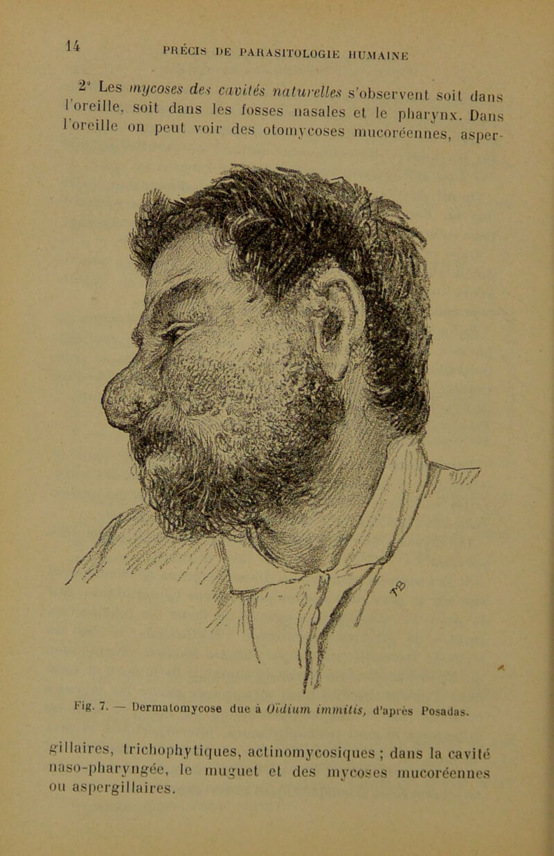 2“ Les imjcoses de.i cavités naturelles s’observent soit dans i oreille, soit dans les fosses nasales et le pharynx. Dans 1 oreille on peut voir des otoniycoses niucoréennes, asper- '■‘S’ 7. Dermatoinycose due à O'idium immitis, d’après Posadas. ^••illaircs, tricliopliyti(|iies, actinoniycosiqnes ; dans la cavité naso-pliaryngée, le nuignet et des mycoses nuicoréenncs ou aspergillaires.