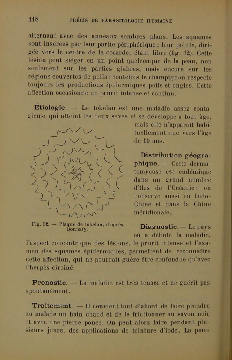 alternant avec des anneaux sombres plans. Les squames sont insérées par leur partie périphérique ; leur pointe, diri- gée vers le centre de la cocarde, étant libre (lig. 52). Cette lésion peut siéger en un point quelconque de la peau, non seulement sur les parties glabres, mais encore sur les régions couvertes de poils ; toutefois le champignun respecte toujours les productions épidermiques poils et ongles. Cette allection occasionne un prurit intense et continu. Etiologie. — Le tokélau est gieuse qui atteint les deux sexes une maladie assez conta- ct se développe à tout âge, mais elle n’apparalt habi- tuellement que vers l’âge de 10 ans. Distribution géogra- phique. — Cette derma- tomycose est endémique dans un grand nombre d’îles de l’Océanie ; on l’observe aussi en Indo- Chiné et dans la Chine méridionale. Diagnostic. — Le pays où a débuté la maladie, l’aspect concentrique des lésions, le prurit intense et l’exa- men des squames épidermiques, permettent de reconnaitre cette allection, qui ne pourrait guère être confondue qu’avec l’herpès circiné. Fig. 52. — Plaque de lokelau, d’après Bonnafy. Pronostic. — La maladie est très tenace et ne guérit pas spontanément. Traitement. — 11 convient tout d’abord de faire prendre au malade un bain chaud et de le frictionner au savon noir et avec une pierre ponce. On peut alors faire pendant plu- sieurs jours, des applications de teinture d'iode. La pom- L