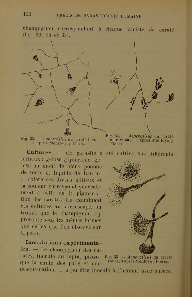 cliampigiion correspondant à chaque variété de caraté (lig. t)3, o4 et 35). Fig. ü3. — AspergUlus du caraté bleu, d’apré.s Monloya y Floiez. Fig. 34. — Aspergillus du caraté noir violacé, d’après Montoya y Fierez. été cultivé sur dilîéreuls Cultures. — Ce parasite a milieux ; gélose glycérinée, gé- lose au moût de bière, pomme de terre et liquide de Haulin. ^ 11 colore ces divers milieux et . ‘ la couleur correspond générale- ment à celle de la pigmenta- À tion des caratés. En examinant ^ ces cultures au microscope, on ' ’ a trouve que le champignon s’y 1 ^ présente sous les mêmes formes (pie celles que l’on observe sur Inoculations expérimenta- les. — Le champignon des ca- ratés, inoculé au lapin, provo- Fig. 55. — Aspergillus du caraté que la chute des poils et une rouge,d après Montoya y Fierez. desquamation. 11 a pu être inoculé à l’homme avec succès.