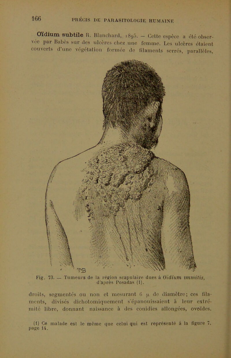 Oïdium subtile R. Hlaiichard, 189.). — Celle espèce a été obser- vée par Babès sur des ulcères chez une femme. Les ulcères étaient couverts d’une vég-étation formée de lllaments serrés, parallèles, Fig. 73. — Tumeurs de la région scapulaire dues à Oïdium nnmitis, d'aiirès Posadas (1). droits, segmentés ou non et mesurant (î p. de diamètre; ces fda- ments, divisés dicbolomiquemcnt s’épanouissaient è leur extré- mité libre, donnant naissance à des couidics allongées, ovoïdes. (t) Ce malade est le même (|uc celui qui est représenté à la figure 7. page U.