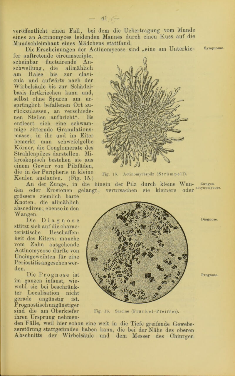 veröffentlicht einen Fall, bei dem die Uebertragung vom Munde eines an Actinomyces leidenden Mannes durch einen Kuss auf die Mundschleimhaut eines Mädchens stattfand. Die Erscheinungen der Actinomycose sind „eine am Unterkie- fer auftretende circumscripte, scheinbar tiuctuirende An- schwellung, die allmählich am Halse bis zur clavi- cula und aufwärts nach der Wirbelsäule bis zur Schädel- basis fortkriechen kann und, selbst ohne Spuren am ur- sprünglich befallenen Ort zu- rückzulassen , an verschiede- nen Stellen aufbricht'4. Es entleert sich eine schwam- mige zitternde Granulations- masse; in ihr und im Eiter bemerkt man schwefelgelbe Körner, die Conglomerate des Strahlenpilzes darstellen. Mi- kroskopisch bestehen sie aus einem Gewirr von Pilzfäden, die in der Peripherie in kleine Fi 15. ActinomvceSpiiz (Strümpell). Keulen auslaufen. (Fig. 15.) An der Zunge, in die hinein der Pilz durch kleine Wun- den oder Erosionen gelangt, verursachen sie kleinere oder grössere ziemlich harte Knoten, die allmählich abscediren; ebenso in den Wangen. Die Diagnose stützt sich auf die charac- teristische Beschaffen- heit des Eiters; manche vom Zahn ausgehende Actinomycose dürfte von Uneingeweihten für eine Periostitis angesehen wer- den. Die Prognose ist im ganzen infaust, wie- wohl sie bei beschränk- ter Localisation nicht gerade ungünstig ist. Prognostisch ungünstiger sind die am Oberkiefer Fig. 16. Sarcine (Frftnk el-Pfeiffer). ihren Ursprung nehmen- den Fälle, weil hier schon eine weit in die Tiefe greifende Gewebs- zerstörung stattgefunden haben kann, die bei der Nähe des oberen Abschnitts der Wirbelsäule und dem Messer des Chiurgen Symptome. Zungen- actynomycose. Diagnose. Prognose.
