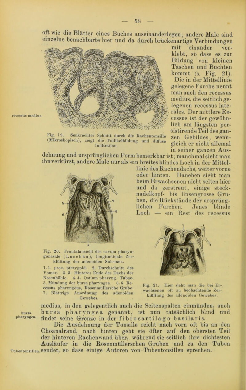 recessus medius. oft wie die Blätter eines Buches auseinanderlegen; andere Male sind einzelne benachbarte hier und da durch brückenartige Verbindungen rav __ mit einander ver- klebt, so dass es zur Bildung von kleinen Taschen und Buchten kommt (s. Fig. 21). Die in der Mittellinie gelegene Furche nennt man auch den recessus medius, die seitlich ge- nen recessus late- Der mittlere Re- cessus ist der gewöhn- lich am längsten per- sistirende Teil des gan- zen Gebildes, wenn- gleich er nicht allemal in seiner ganzen Aus- Fig. I 9. Senkrechter Schnitt durch die Rachentonsille (Mikroskopisch), zeigt die Follikelbildung und diffuse Infiltration. dehnung und ursprünglichen Form bemerkbar ist; manchmal sieht man ihn verkürzt, andere Male nur als ein breites blindes Loch in der Mittel- linie des Rachendachs, weiter vorne oder hinten. Daneben sieht man beim Erwachsenen nicht selten hier und da zerstreut, einige steck- nadelkopf- bis linsengrosse Gru- ben, die Rückstände der ursprüng- lichen Furchen. Jenes blinde Loch — ein Rest des recessus Fig. 20. Frontalansicht des eavum pharyu- gonasale (Luschka), longitudinale Zer- klüftung der adenoiden Substanz. 1.1. proc. pterygoid. 2. Durchschnitt des Vomer. 3. 3. Hinteres Ende des Dachs der Nasenhöhle. 4.4. Ostium pliaryng. Tubae. 5. Mündung der bursa pharyngea. 6.6. Re- cessus pharyngeus, Rosenmüllersche Grube. 7. Blättrige Anordnung des adenoiden Gewebes. Fig. 21. Hier sieht man die bei Er- wachsenen oft zu beobachtende Zer- klüftung des adenoiden Gewebes. medius, in den gelegentlich auch die Seitenspalten einmünden, auch bursa bursa pharyngea genannt, ist nun tatsächlich blind und pharyngea. seine Grenze in der fibrocartilago basilaris. Die Ausdehnung der Tonsille reicht nach Vorn oft bis an den Choanalrand, nach hinten geht sie öfter auf den obersten Teil der hinteren Rachenwand über, während sie seitlich ihre dichtesten Ausläufer in die Rosenmüllerschen Gruben und zu den Tuben Tubentonsillen. sendet, so dass einige Autoren von Tubentonsillen sprechen.